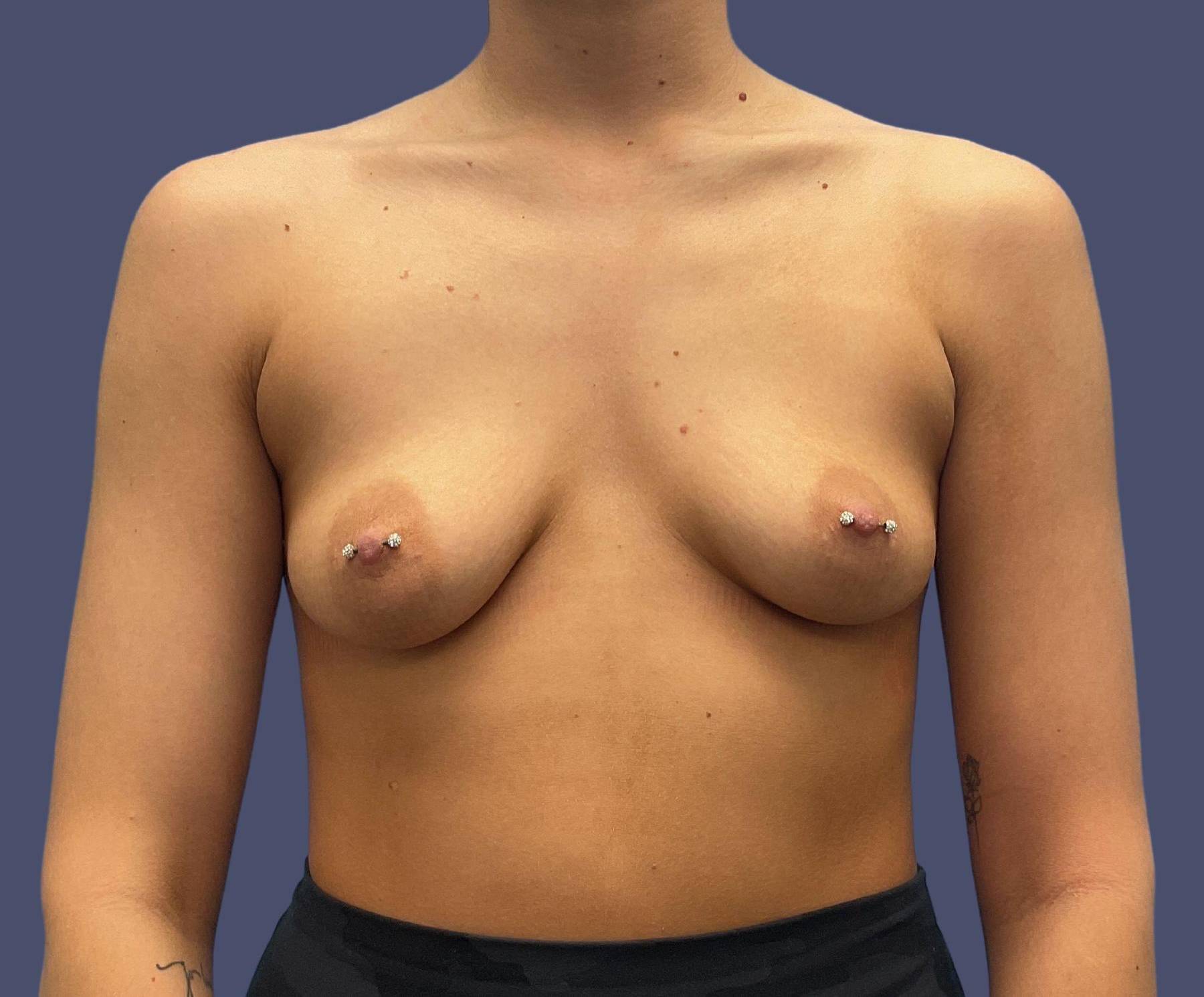 Breast Augmentation 35 Before