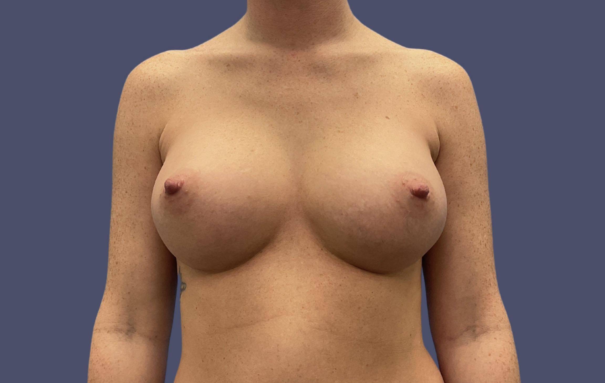 Breast Augmentation 4 After