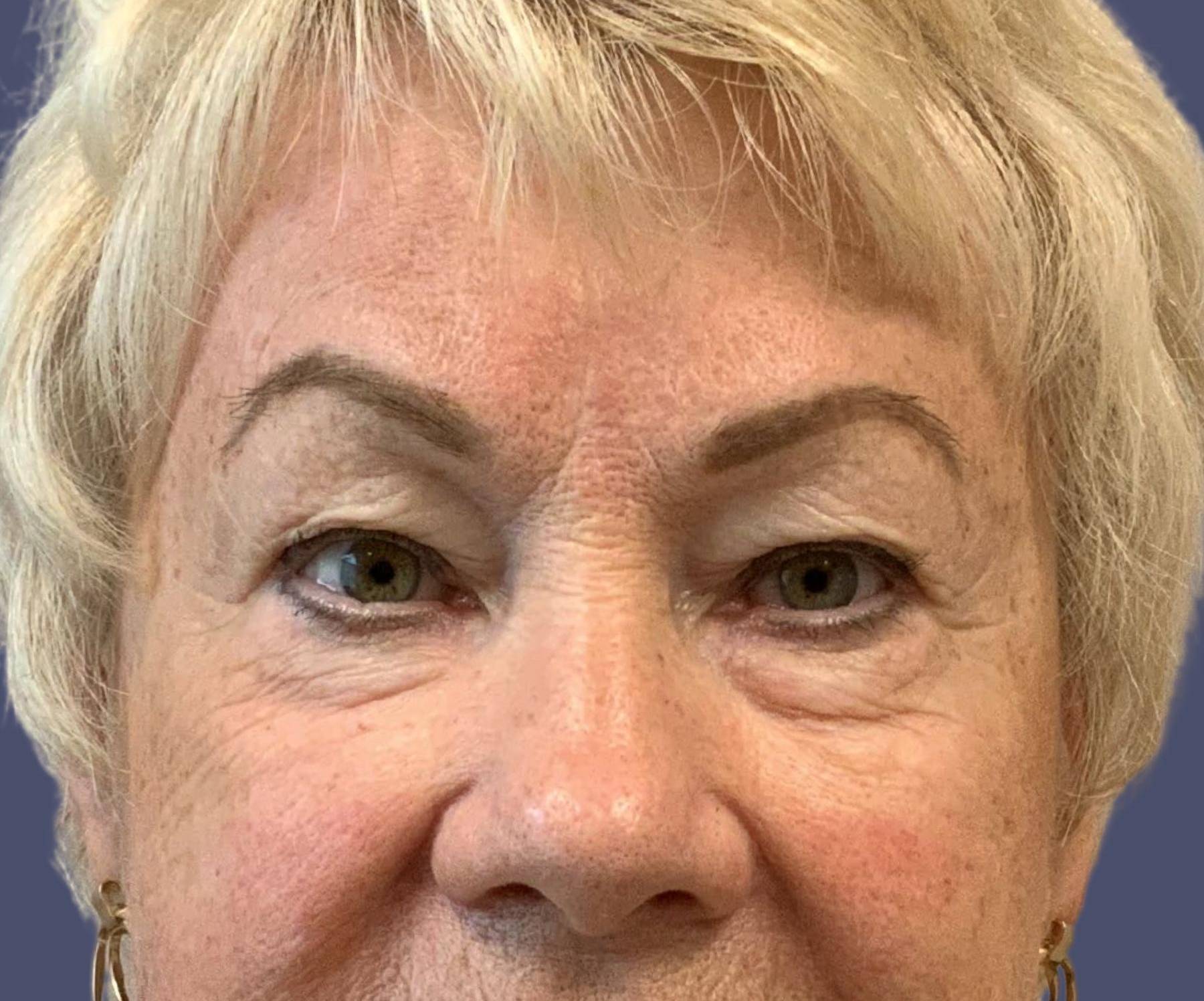 Upper Blepharoplasty 4 Before
