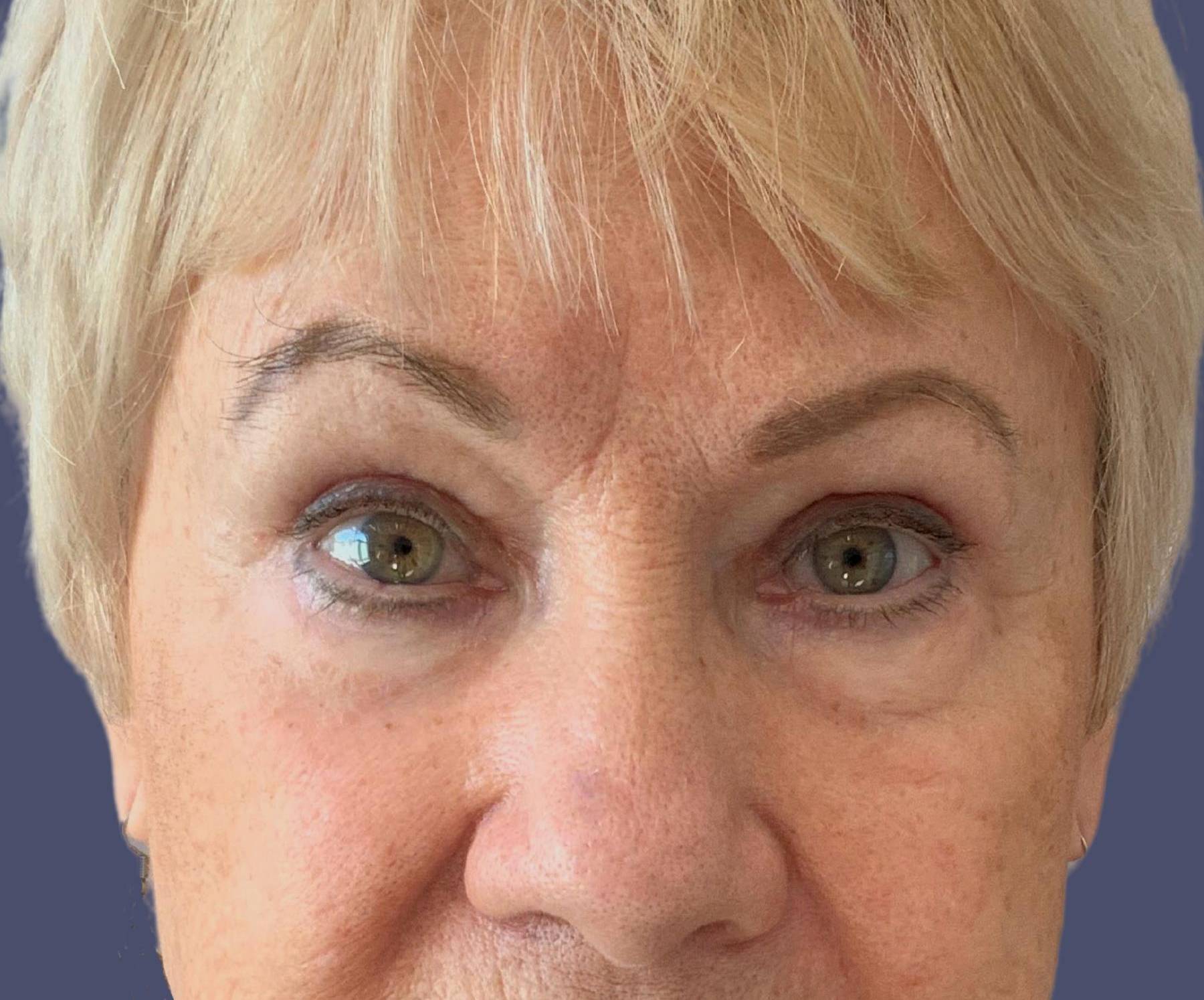 Upper Blepharoplasty 4 After