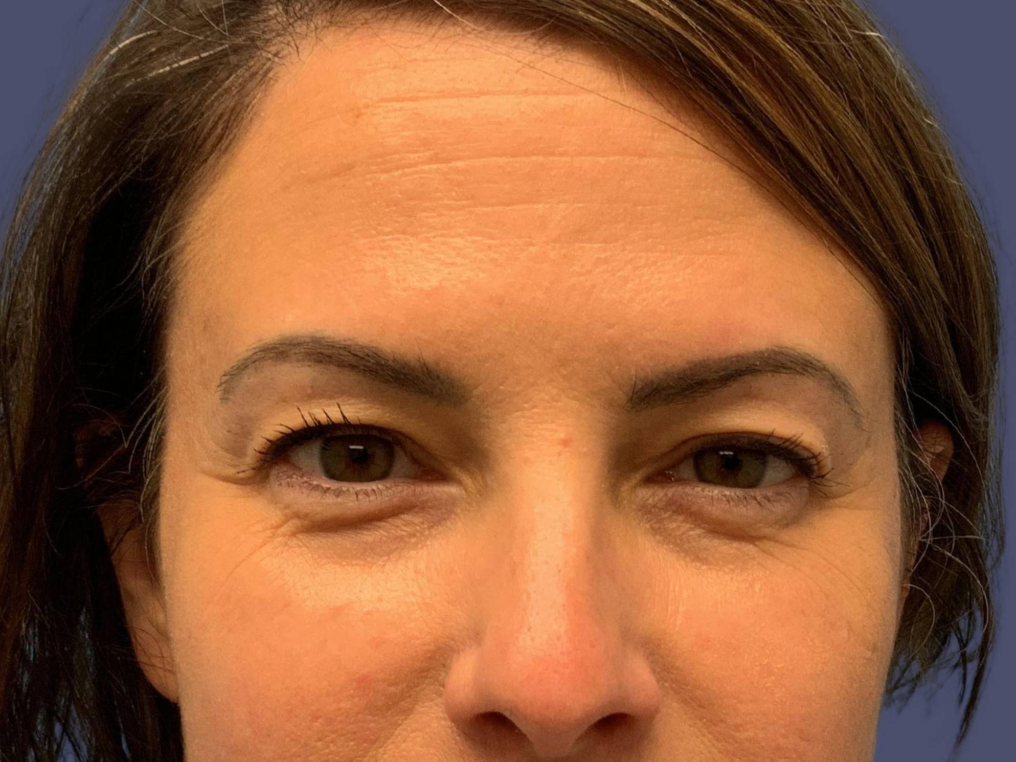 Upper Blepharoplasty 7 Before