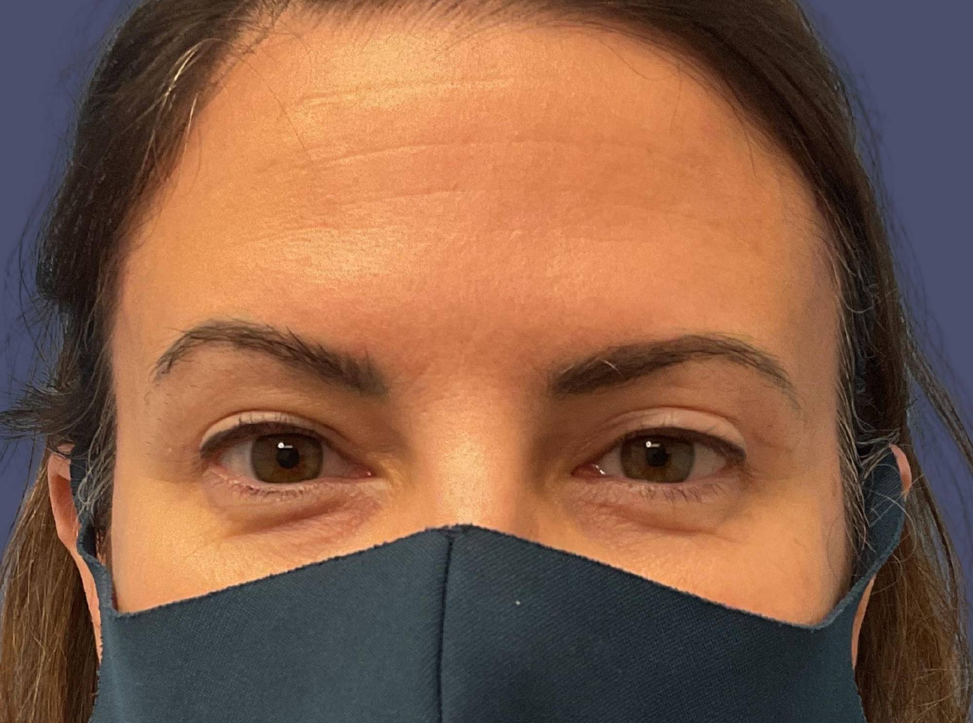 Upper Blepharoplasty 7 After