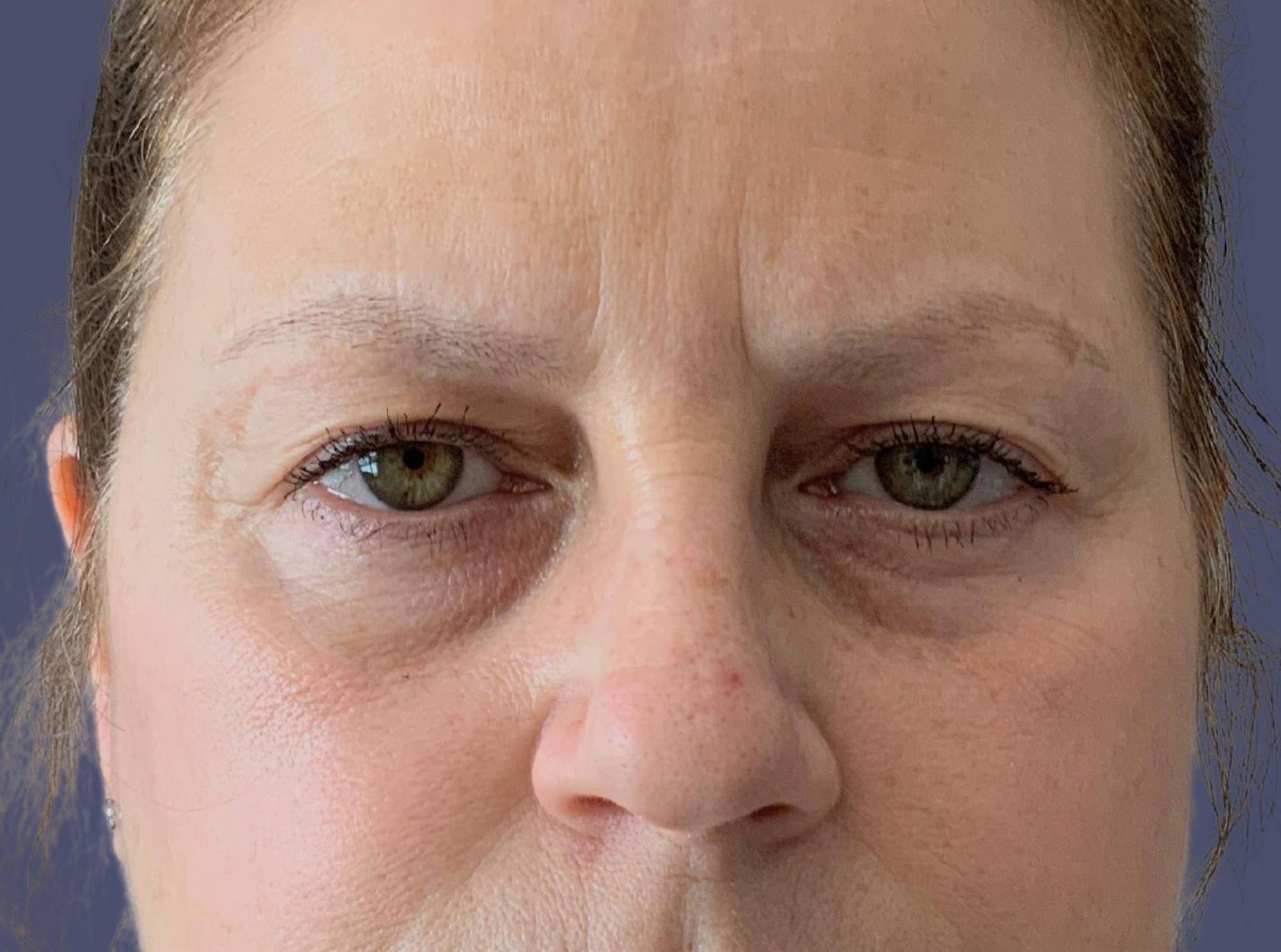 Upper Blepharoplasty 8 Before