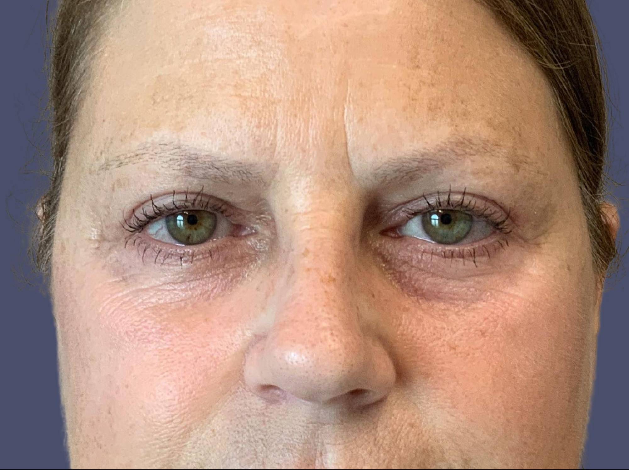 Upper Blepharoplasty 8 After