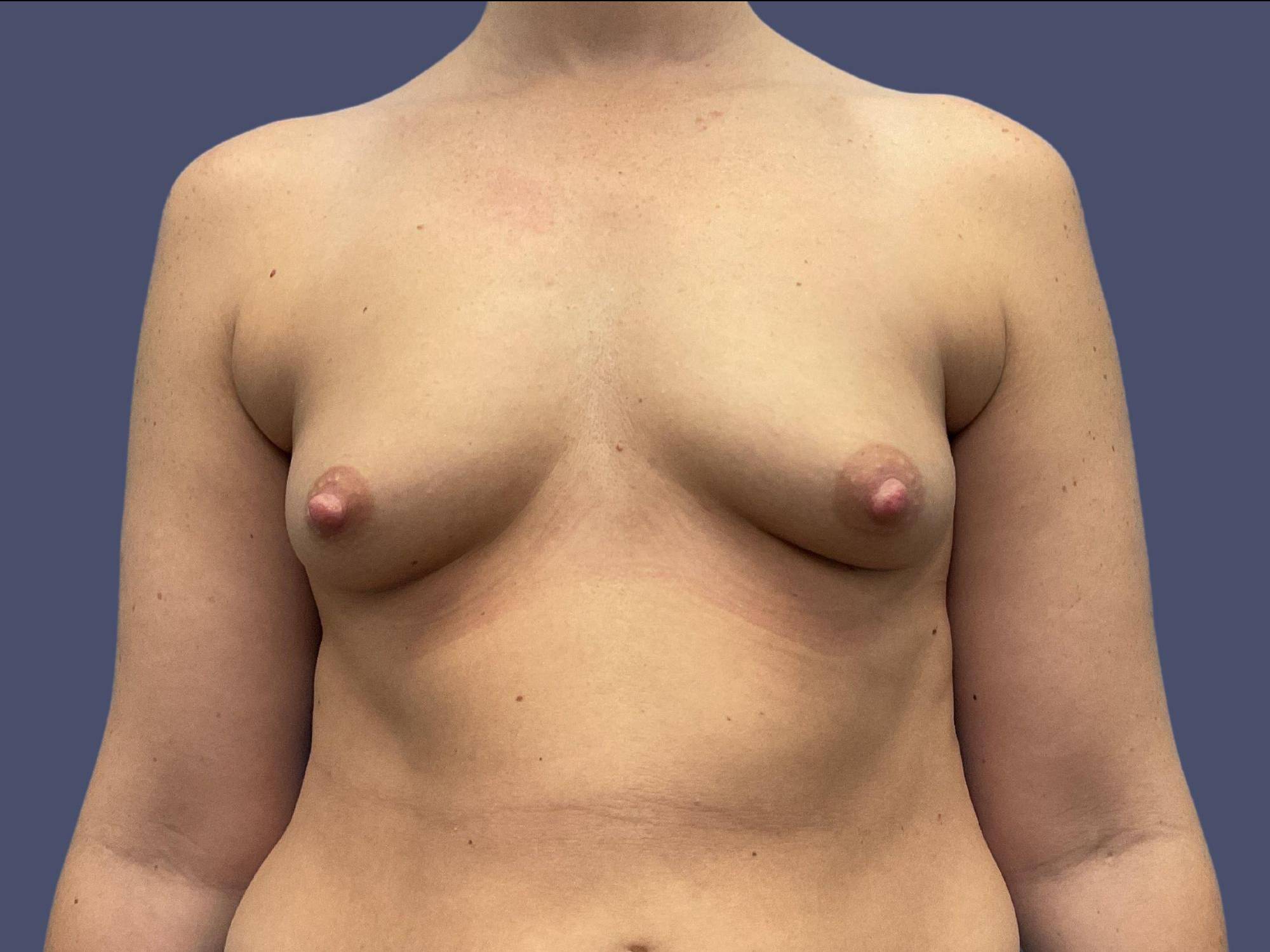 Breast Lift w/Augmentation 2 Before