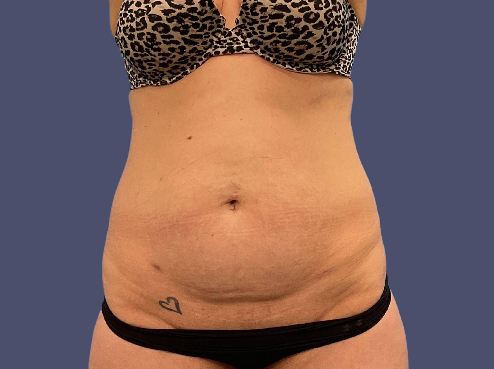 Abdominoplasty (Tummy Tuck) 28 Before