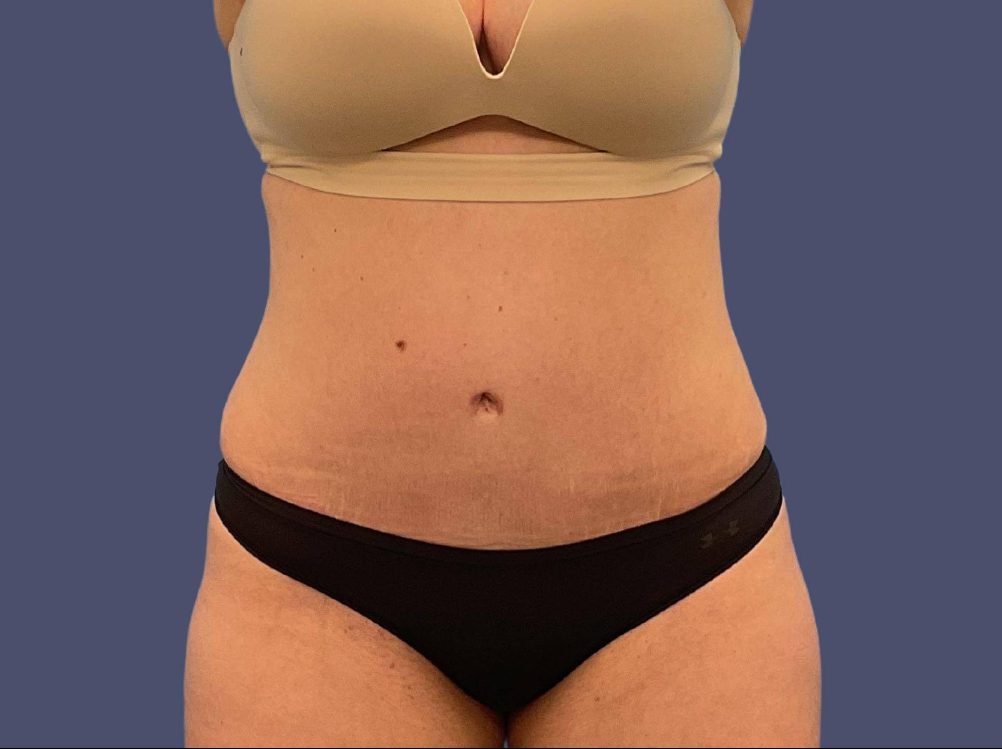 Abdominoplasty (Tummy Tuck) 28 After