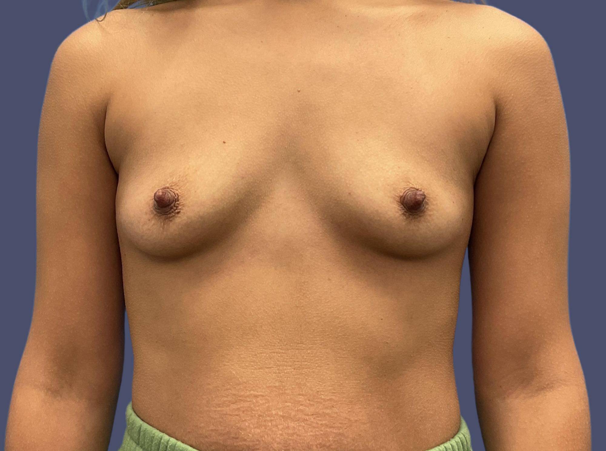 Breast Augmentation 8 Before