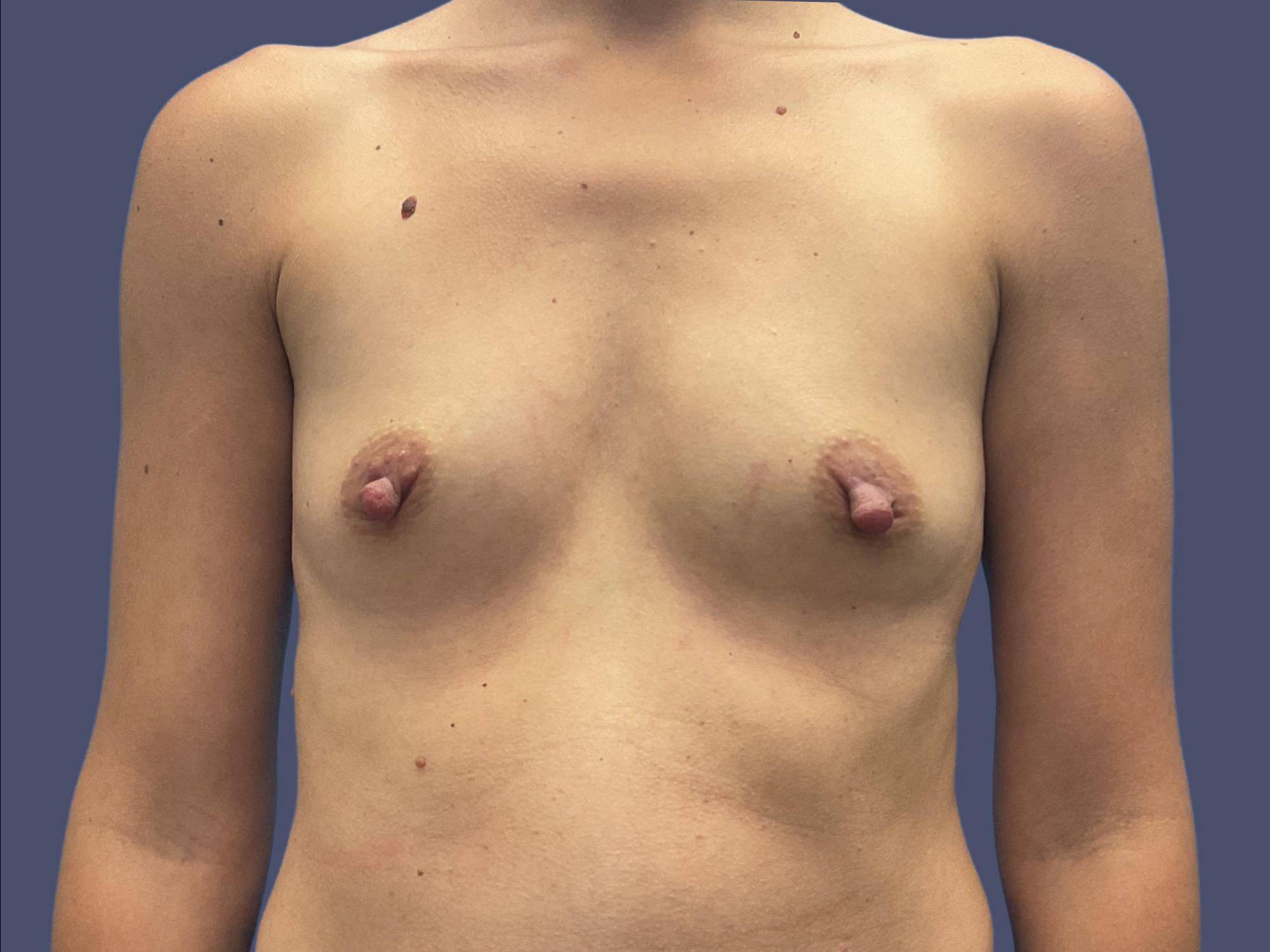 Breast Augmentation 45 Before