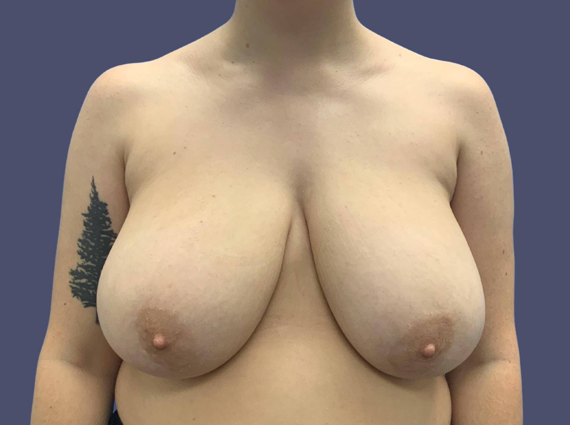 Breast Reduction 4 Before