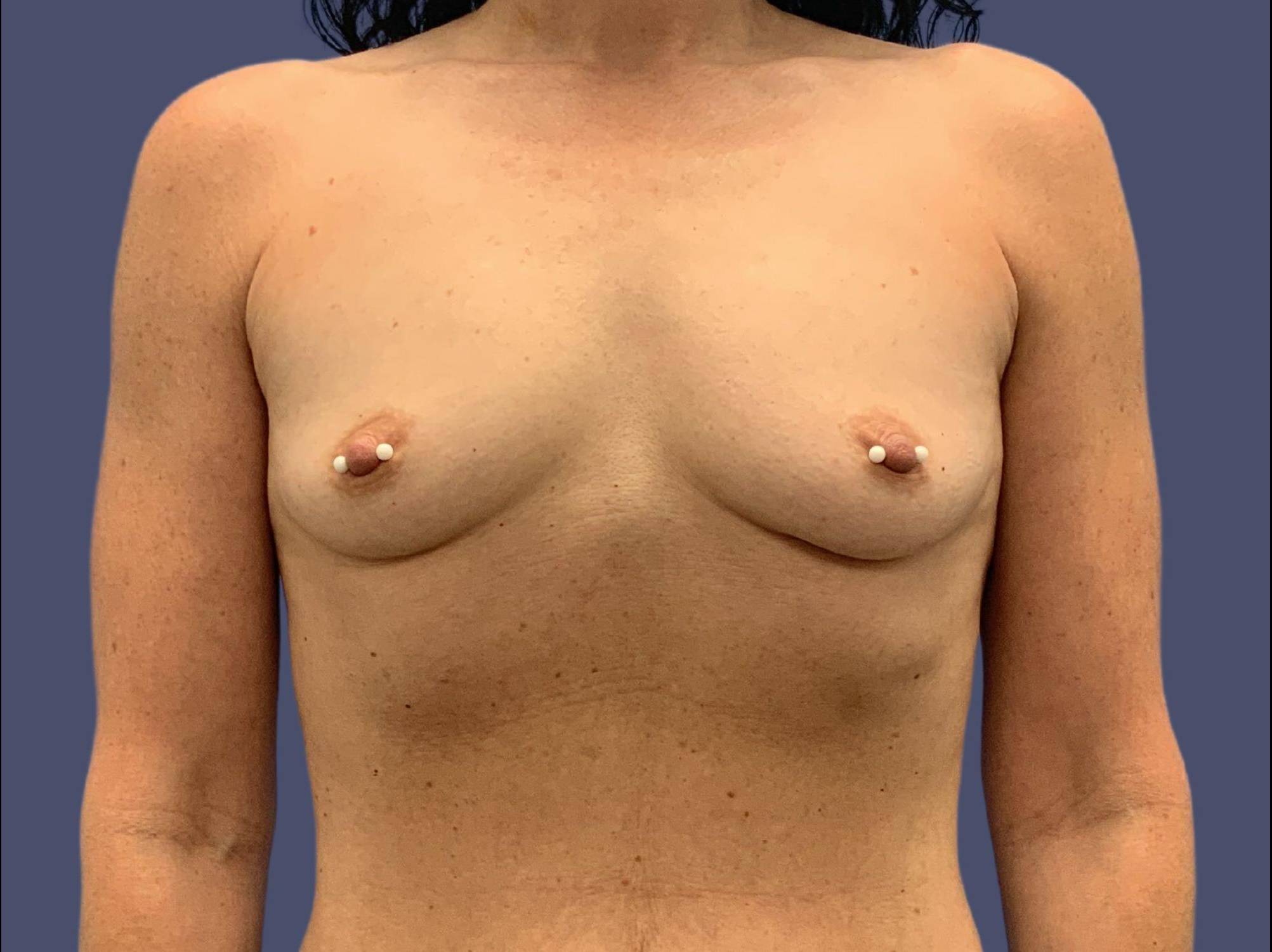 Breast Augmentation 17 Before