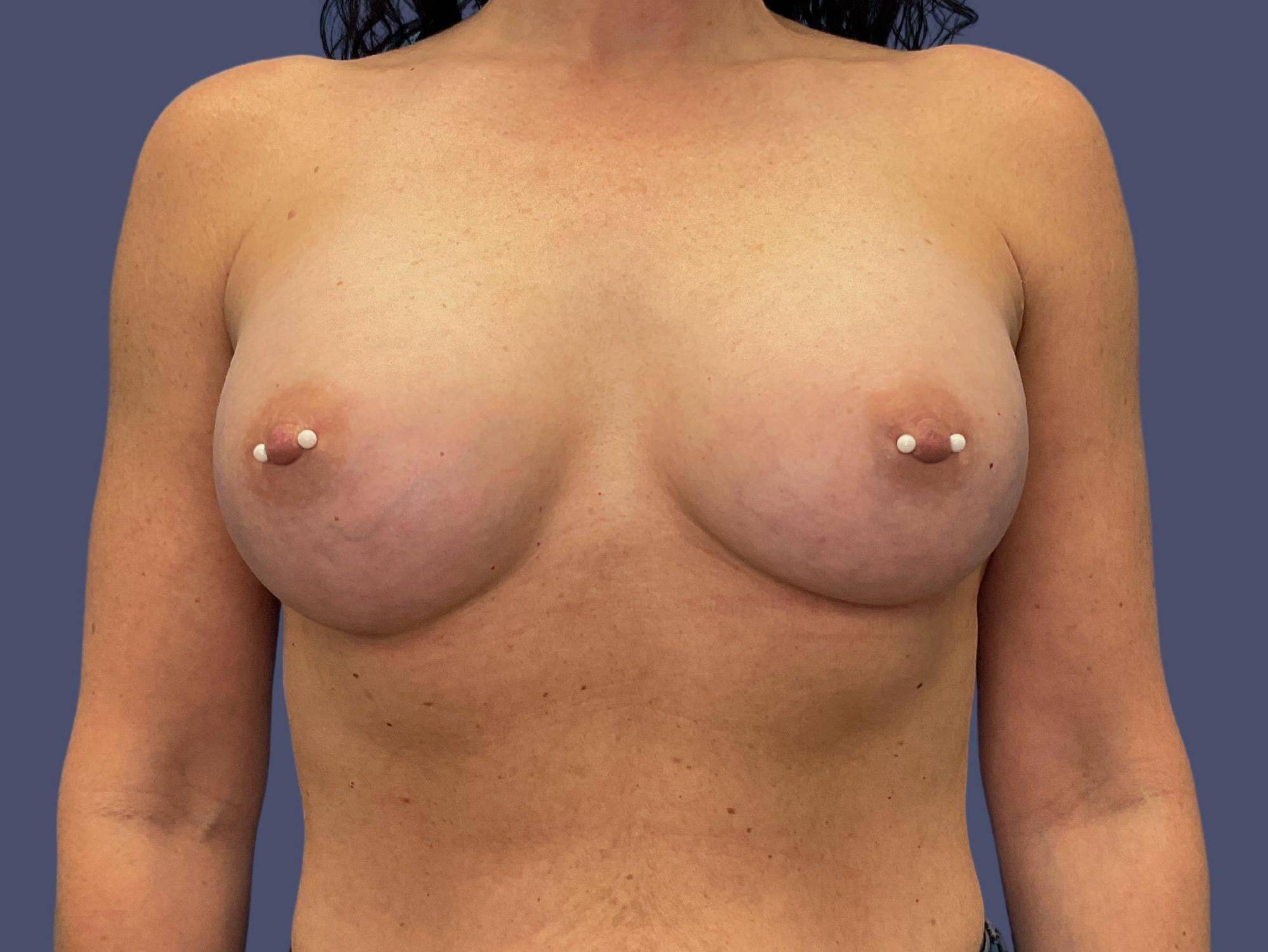 Breast Augmentation 17 After