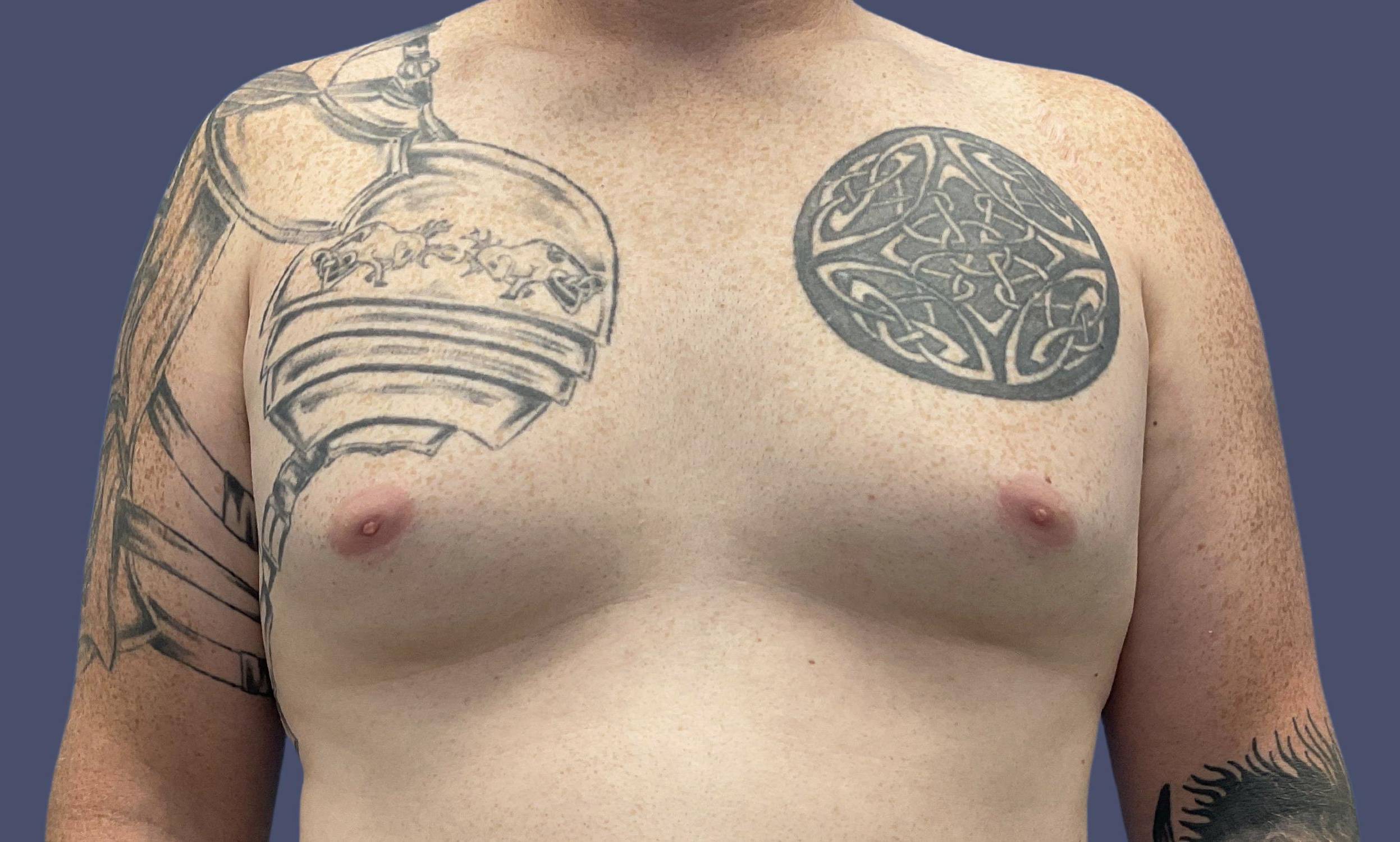 Gynecomastia 1 Before