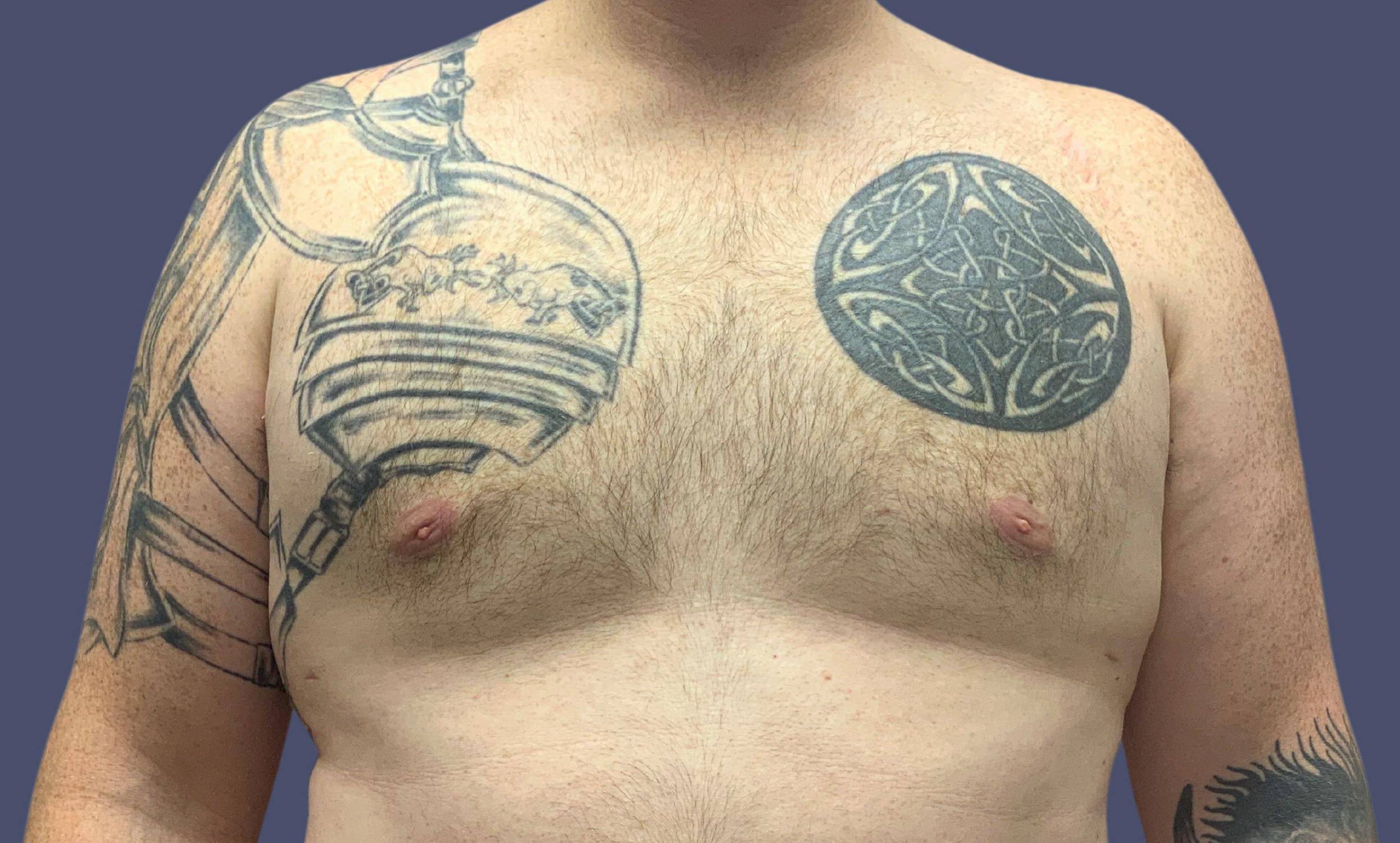 Gynecomastia 1 After