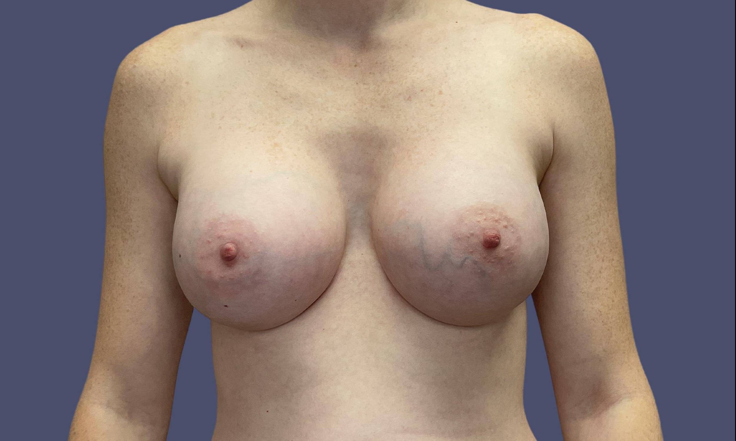 Breast Augmentation 26 After