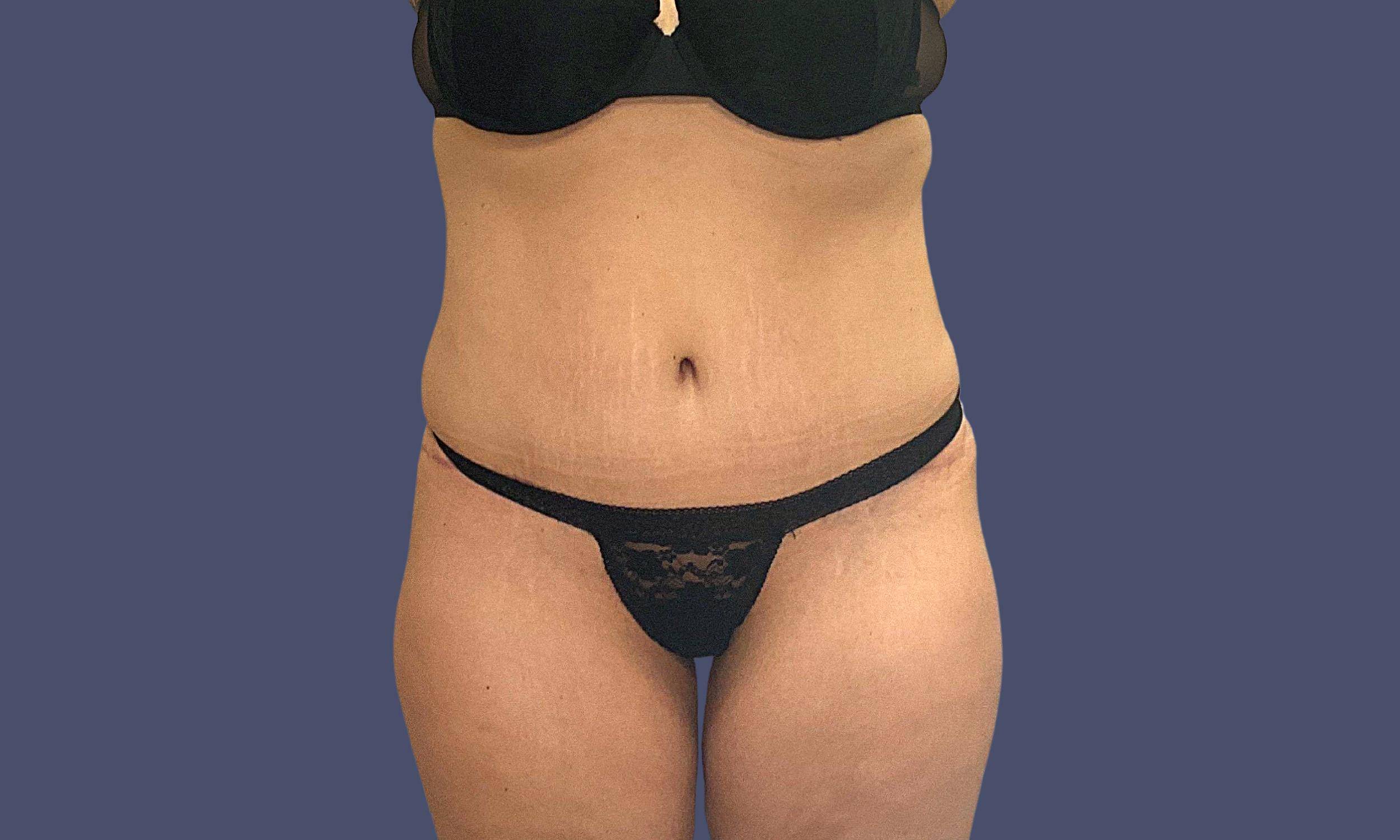 Abdominoplasty (Tummy Tuck) 1 After