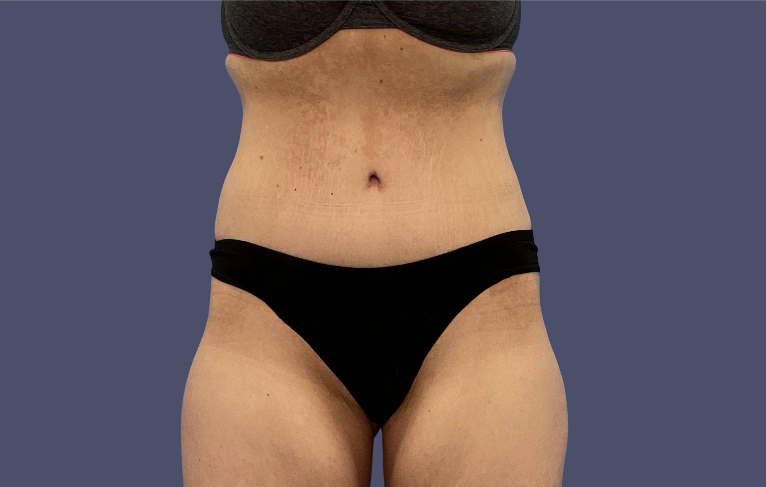 Abdominoplasty (Tummy Tuck) 29 After