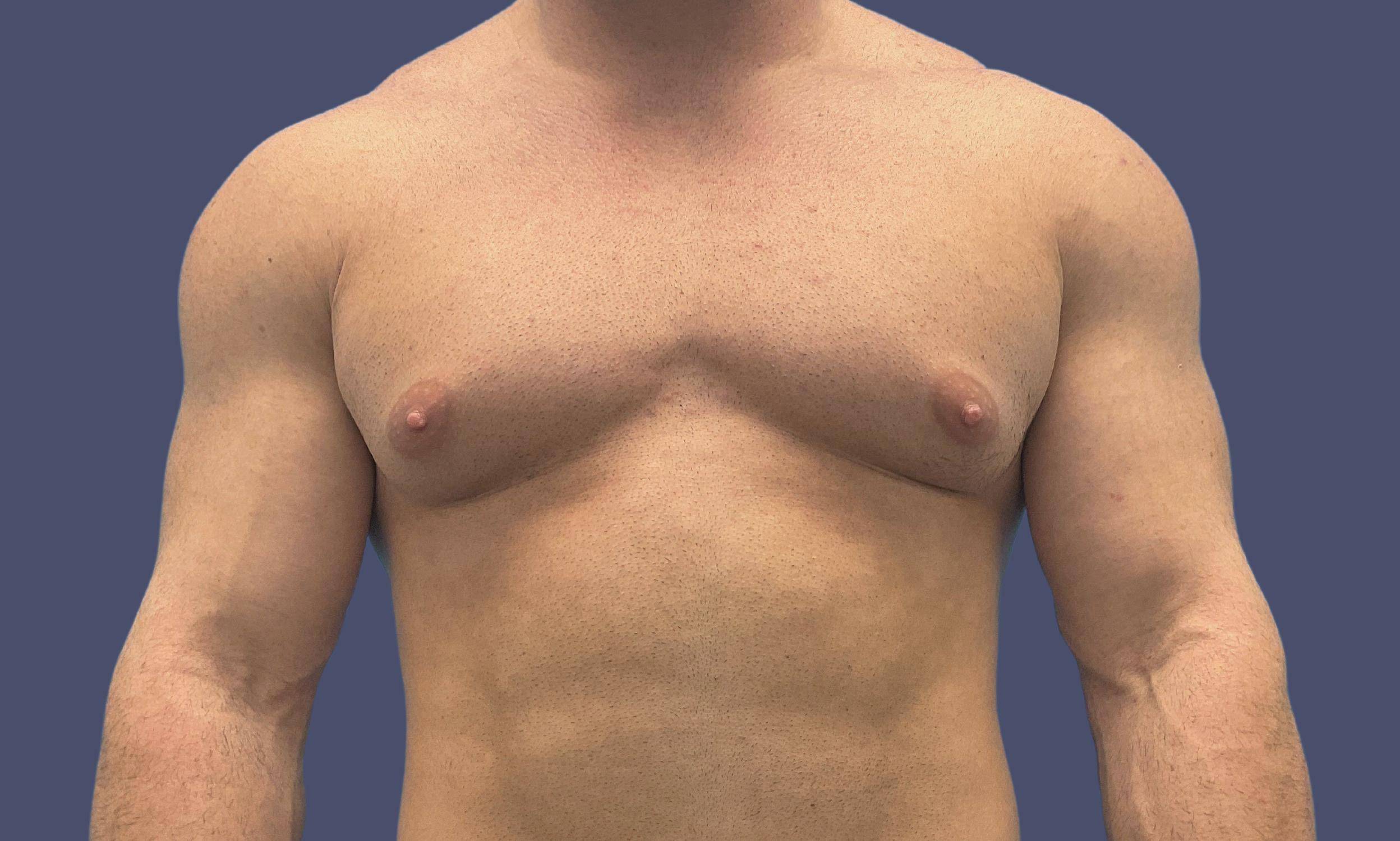 Gynecomastia 2 Before