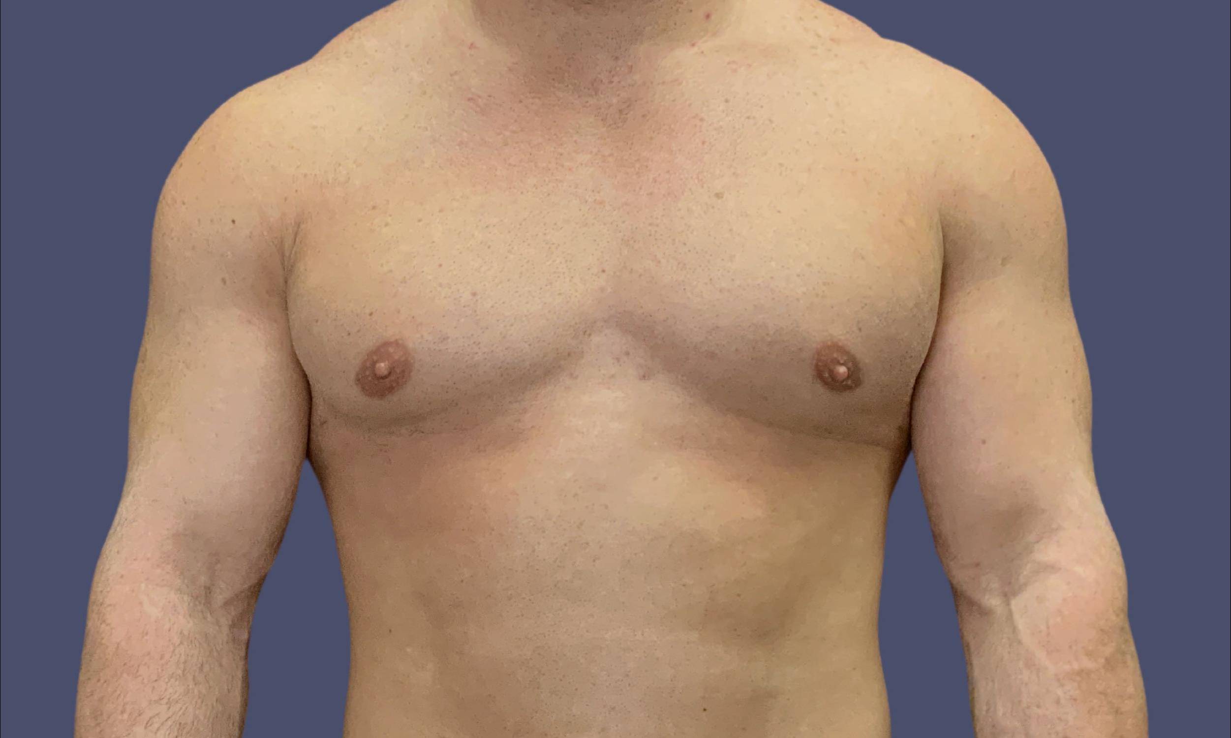 Gynecomastia 2 After