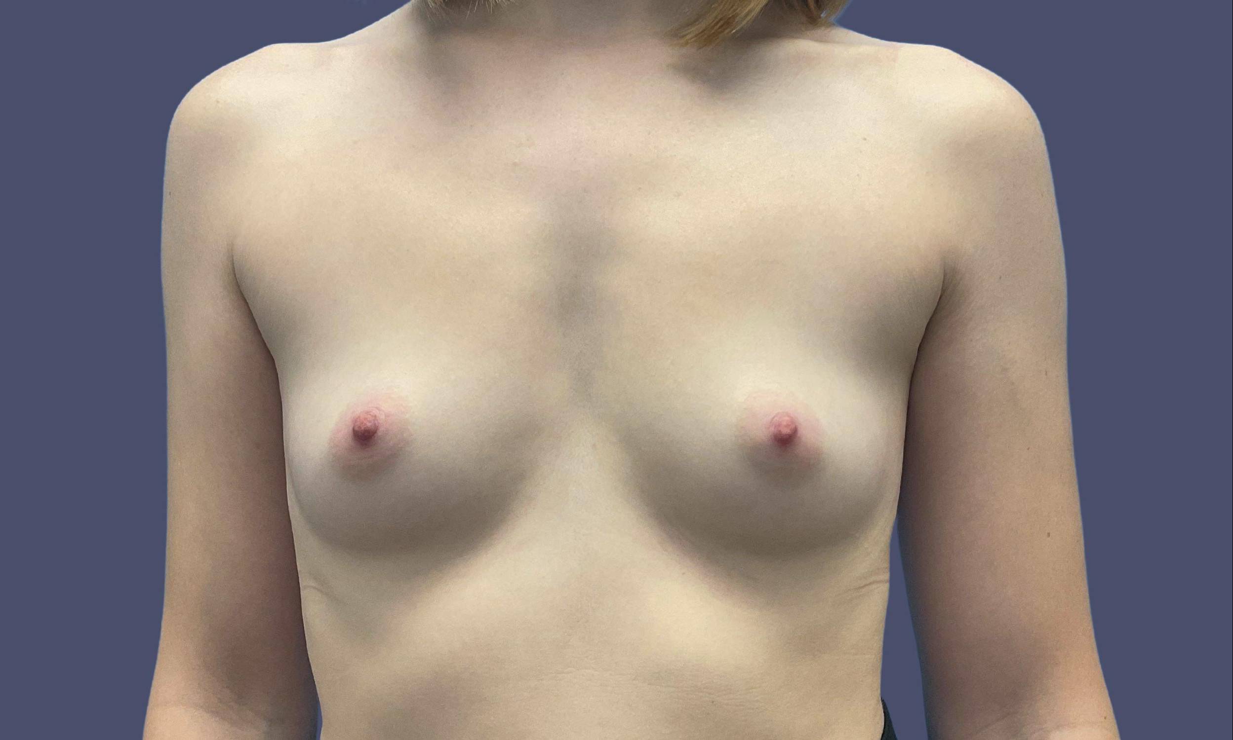 Breast Augmentation 14 Before