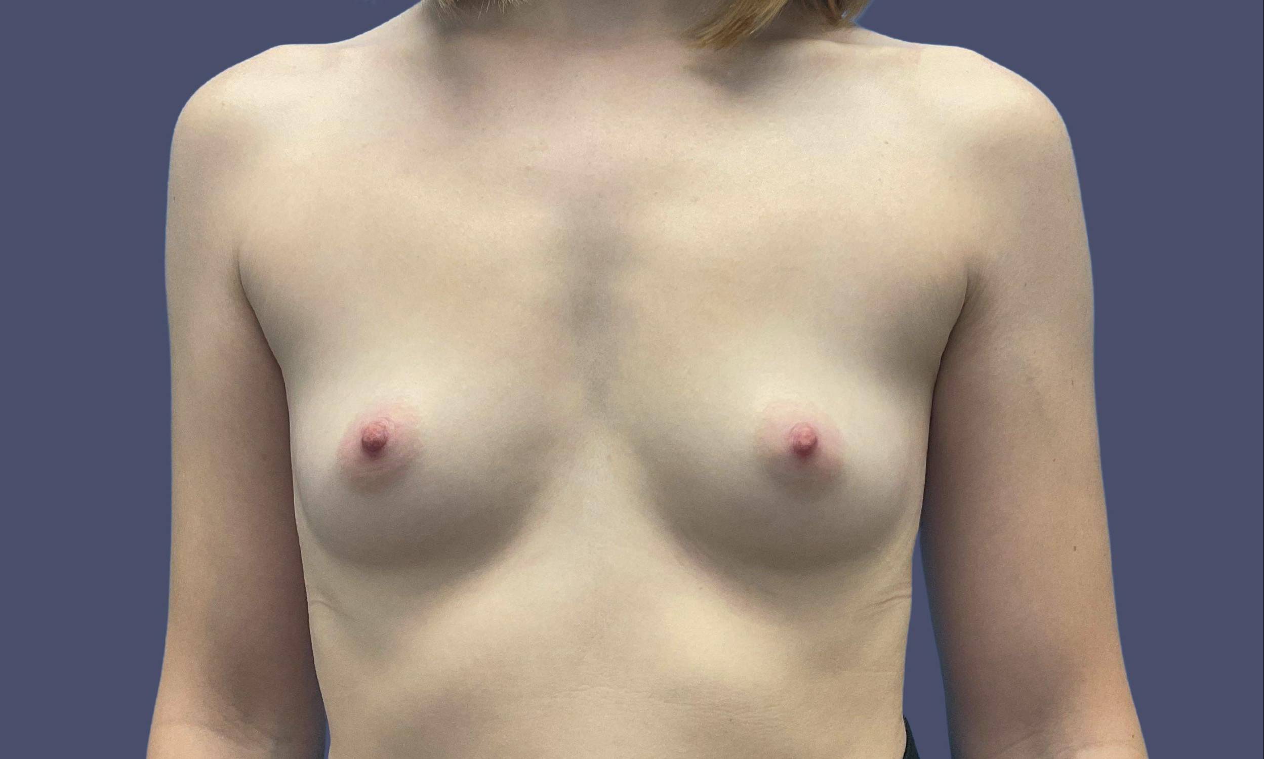 Breast Augmentation 18 Before