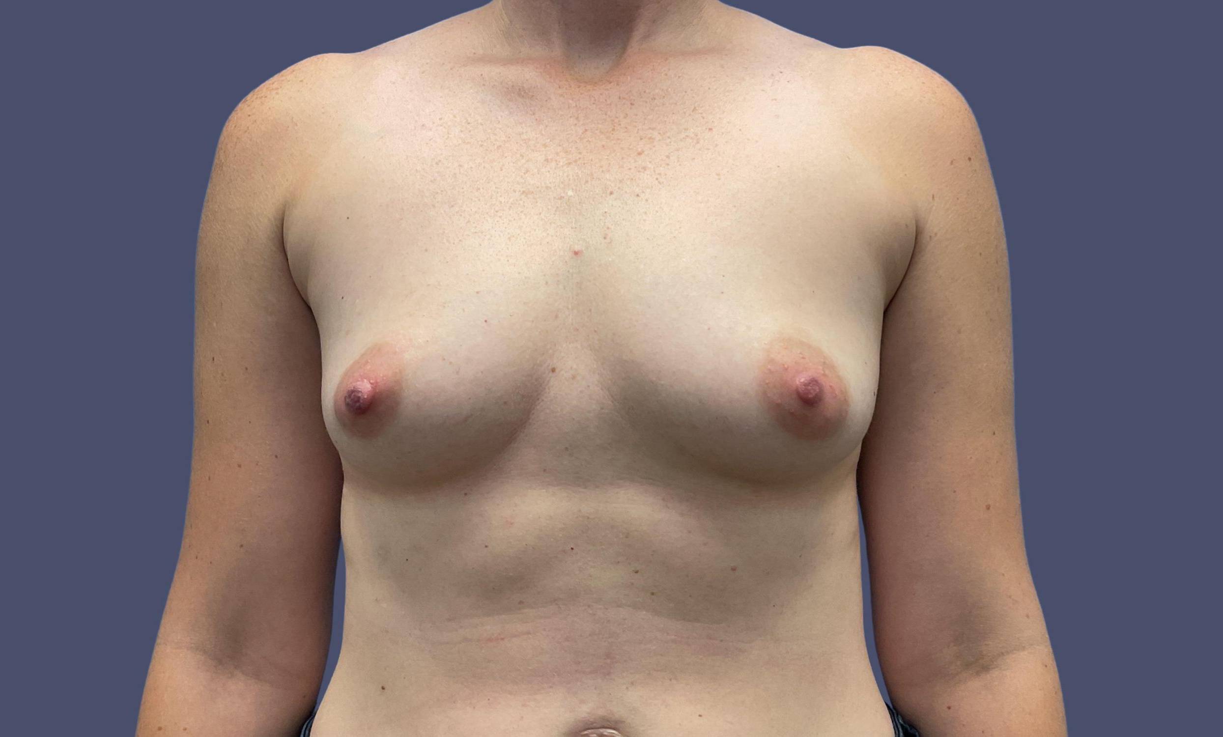 Breast Augmentation 40 Before