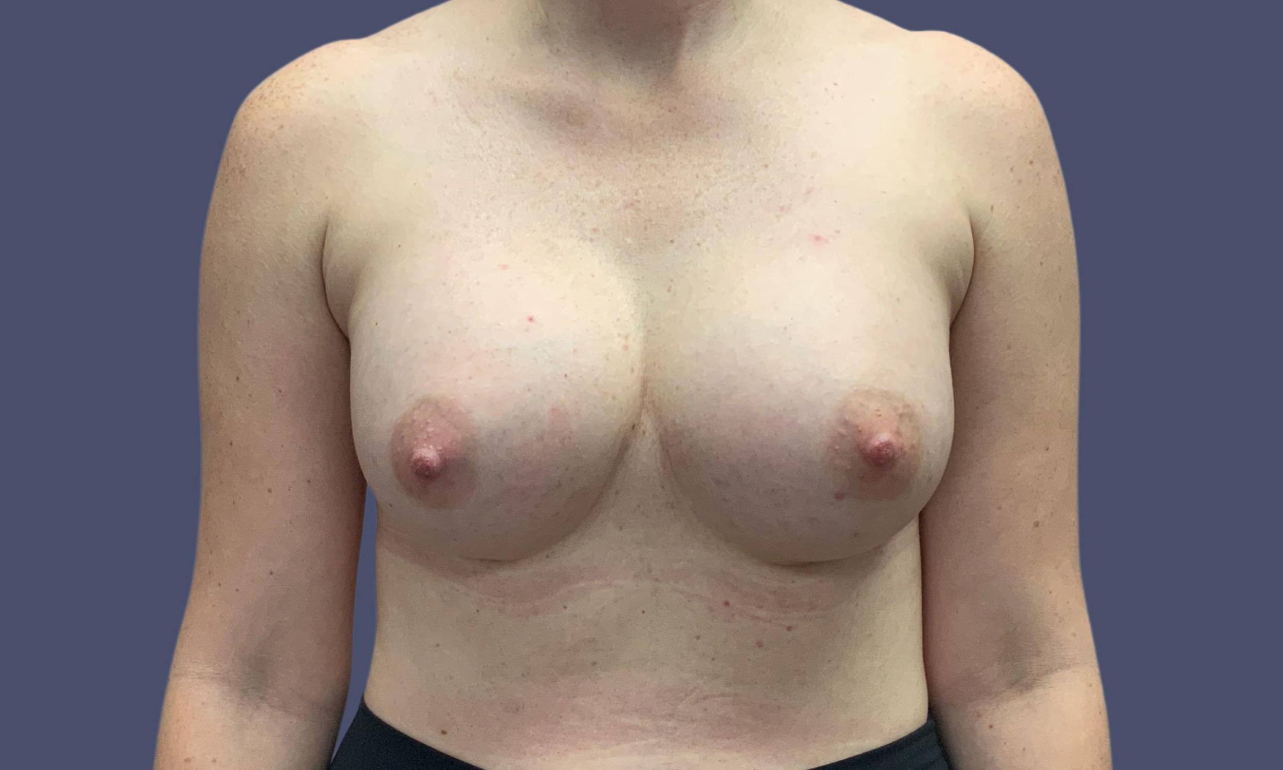 Breast Augmentation 55 After