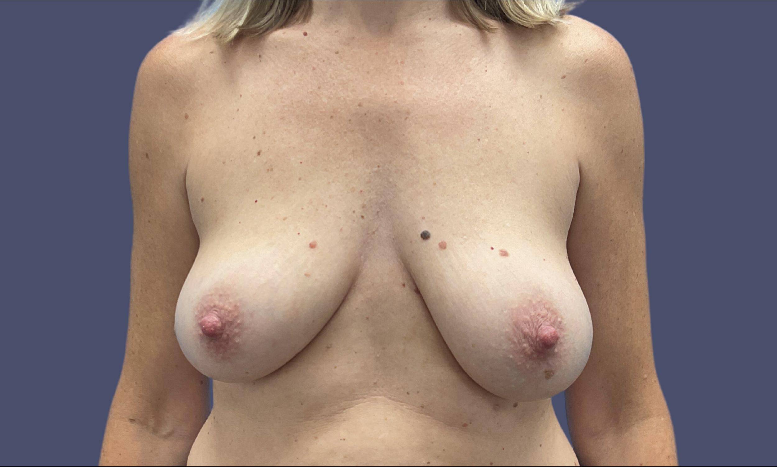Breast Reduction with Augmentation 1 Before