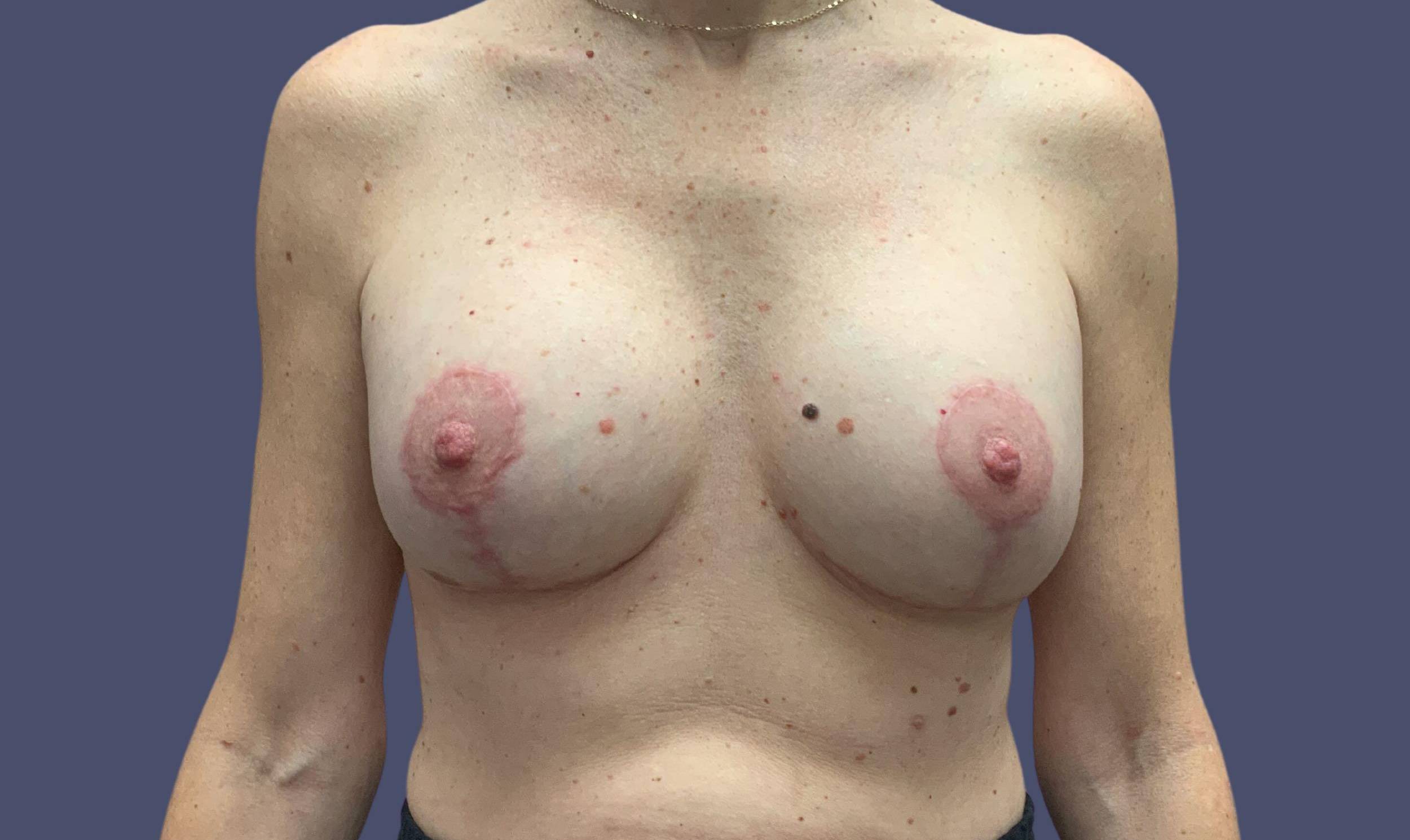 Breast Reduction with Augmentation 1 After