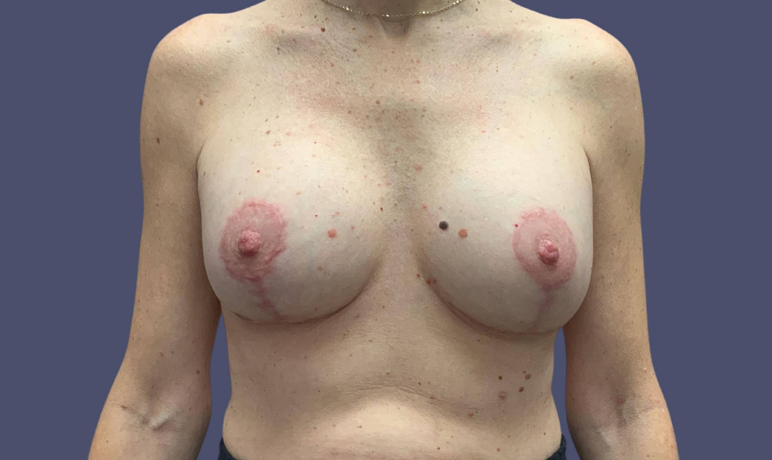 Breast Reduction with Augmentation 2 After