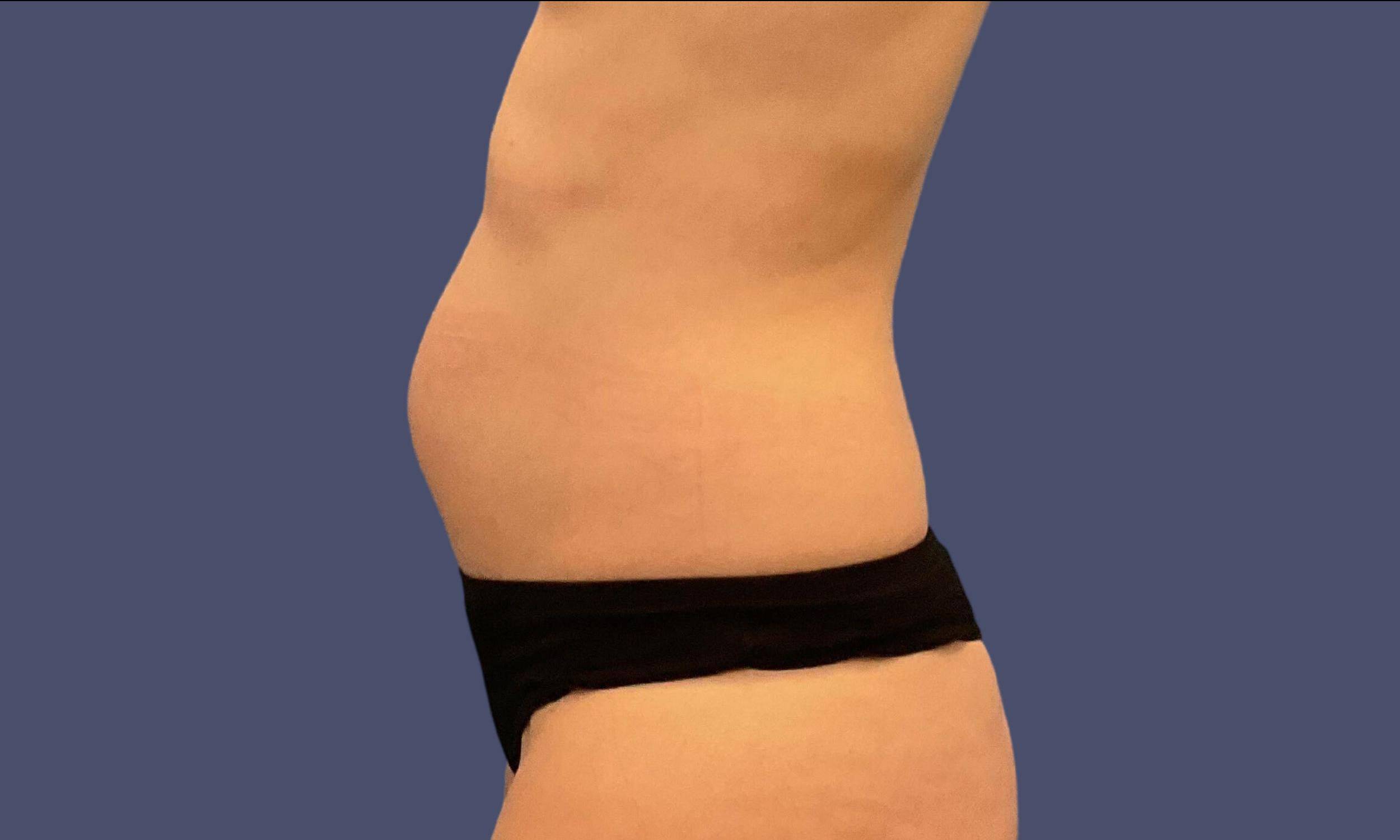 Liposuction 3 - Abdomen Before