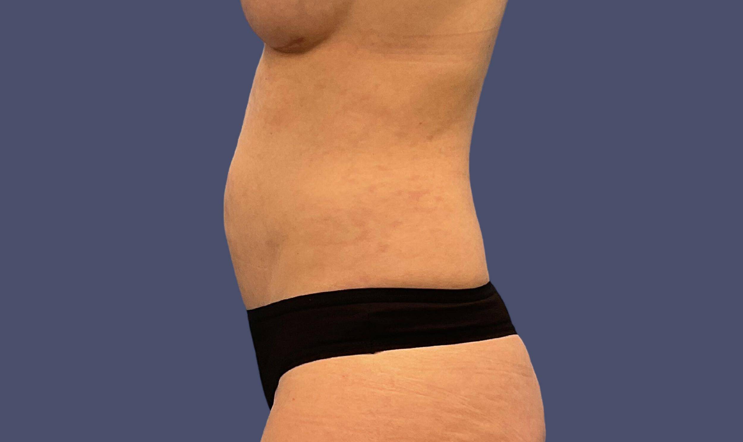 Liposuction 3 - Abdomen After
