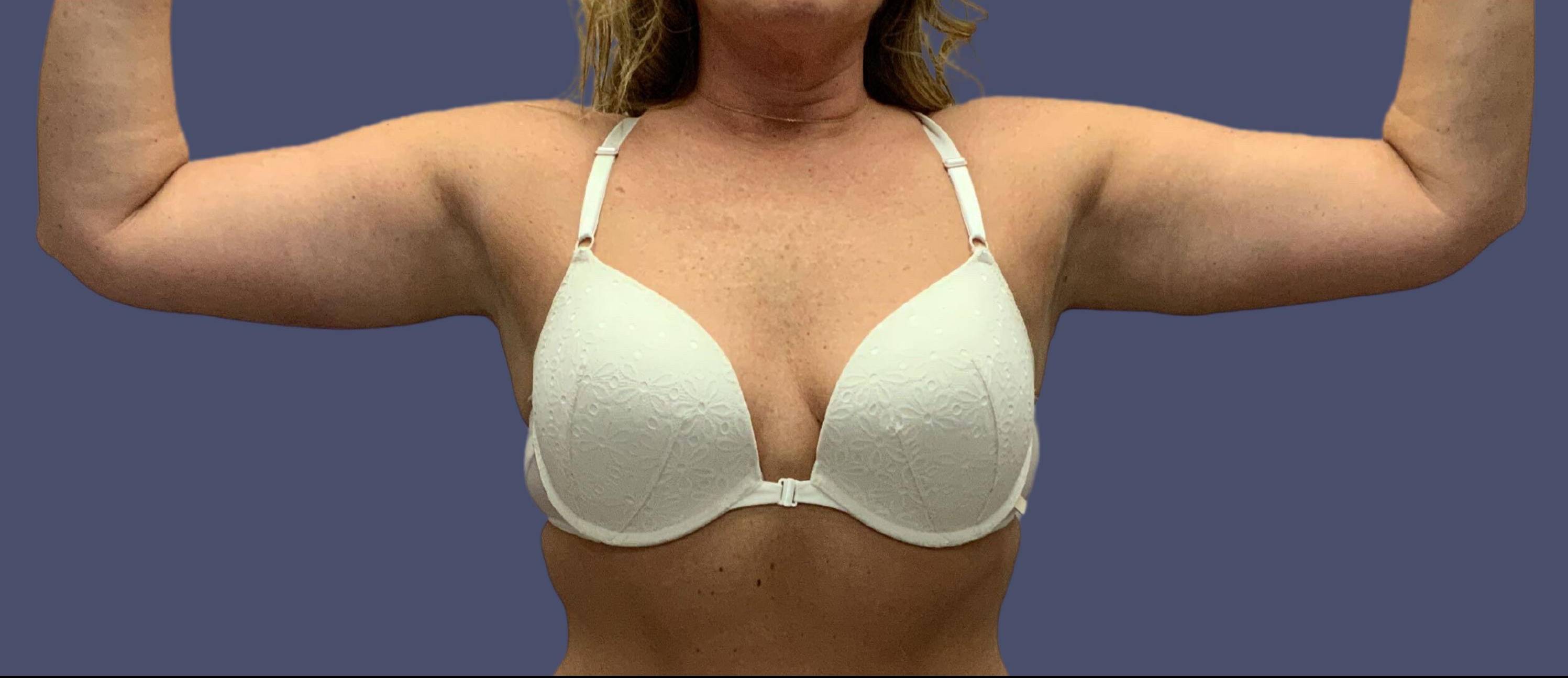 Brachioplasty (Arm Lift) 7 After