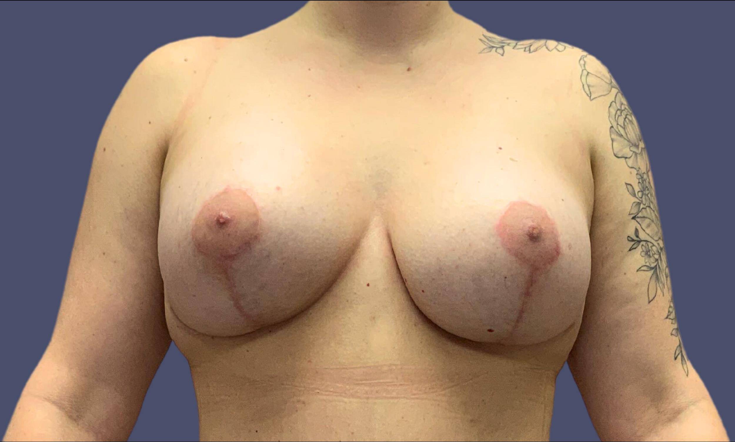 Breast Reduction with Augmentation 3 After