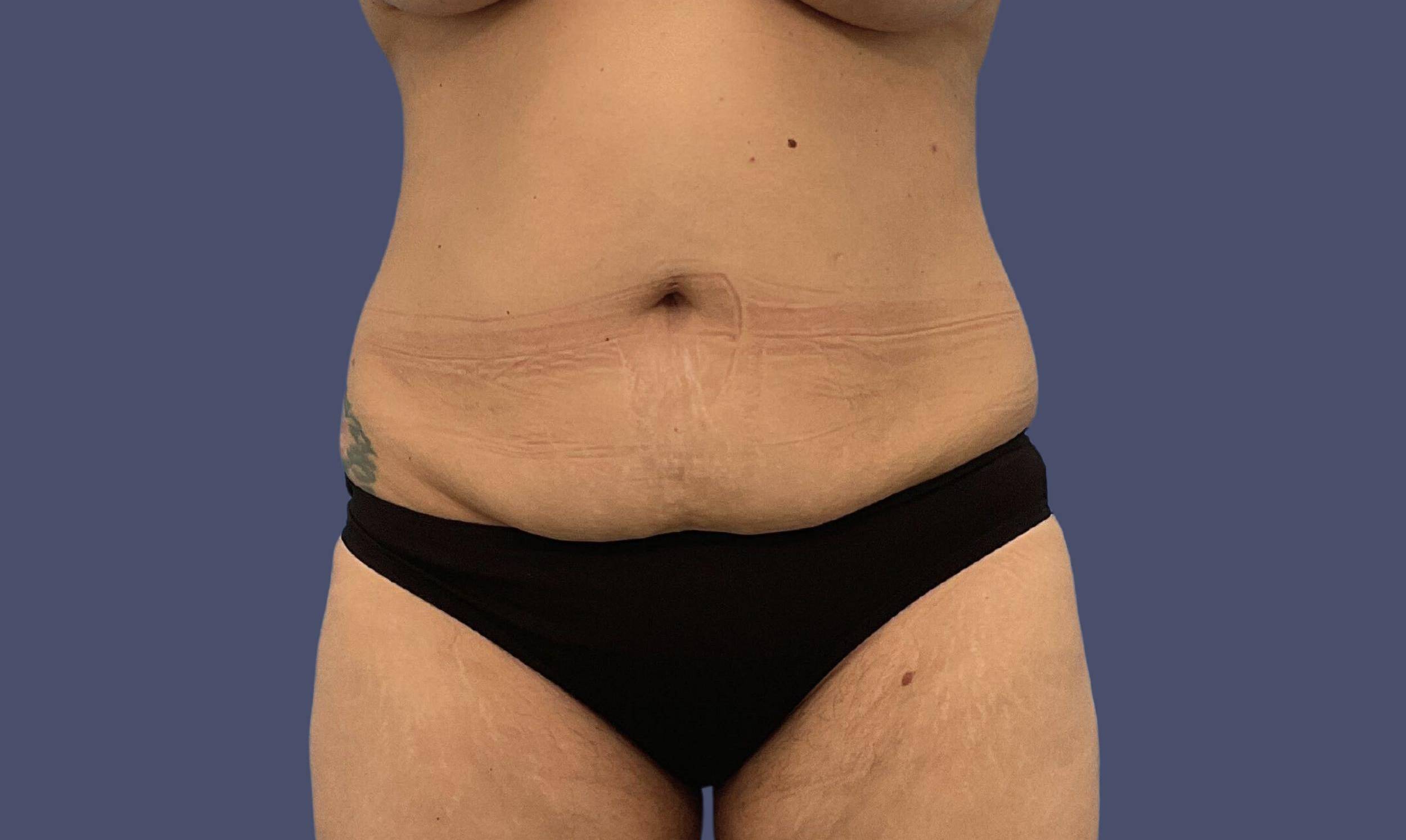 Abdominoplasty (Tummy Tuck) 14 Before