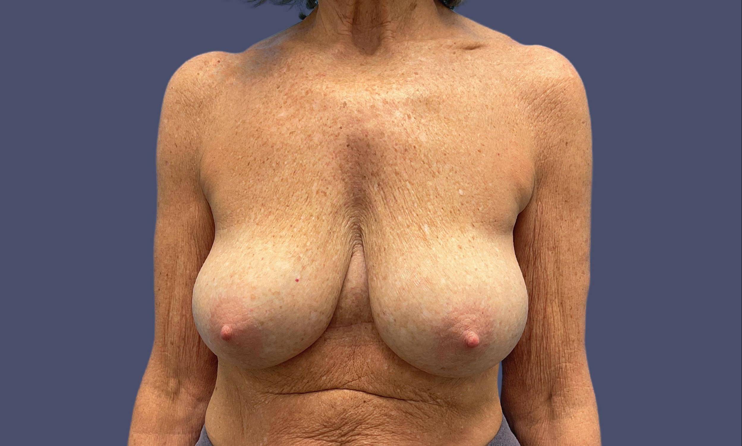 Breast Reduction with Augmentation 6 Before