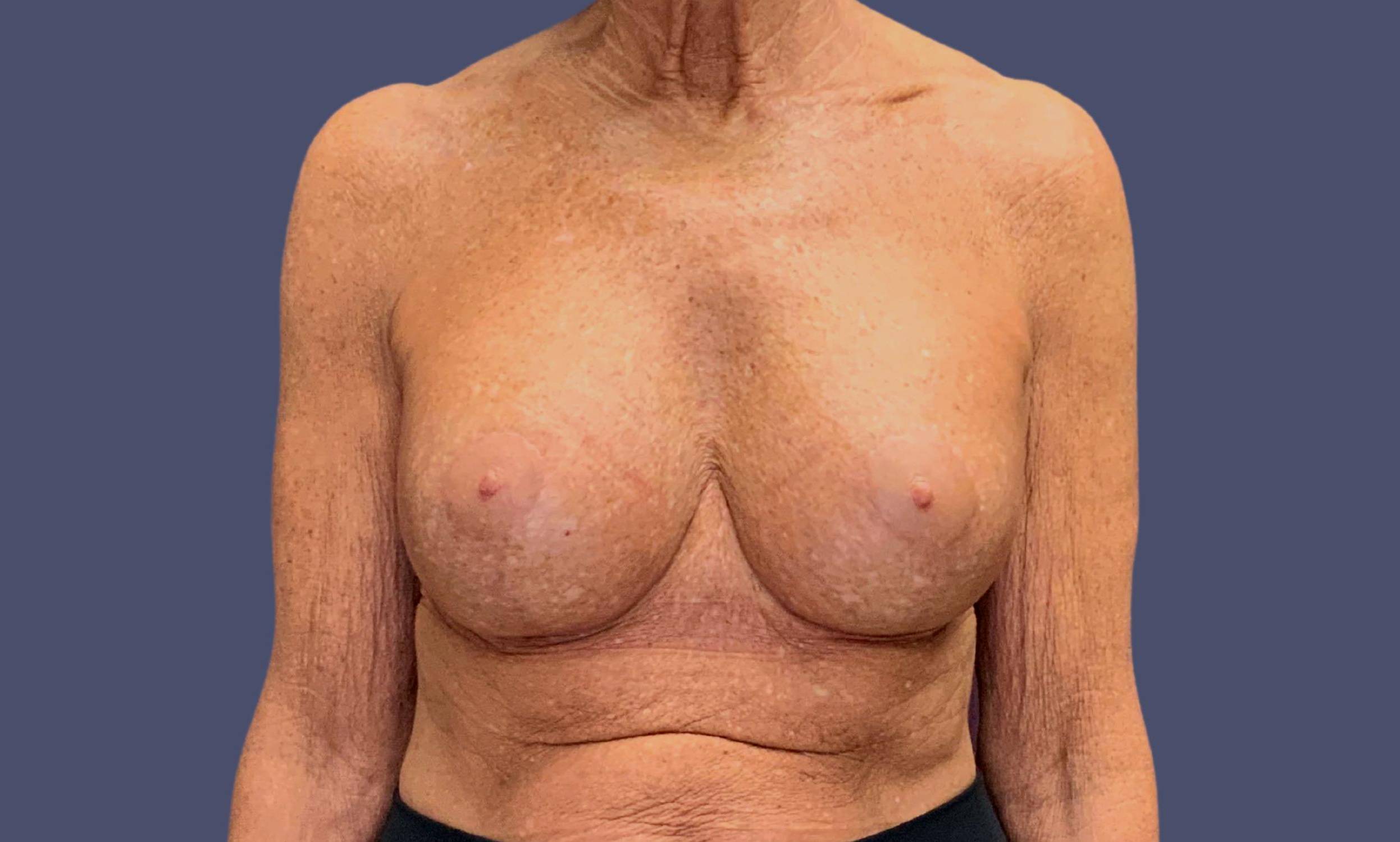 Breast Reduction with Augmentation 7 After