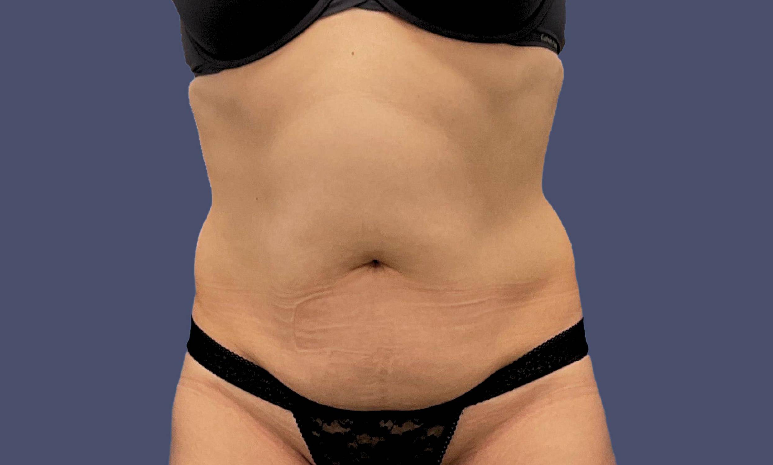 Abdominoplasty (Tummy Tuck) 16 Before