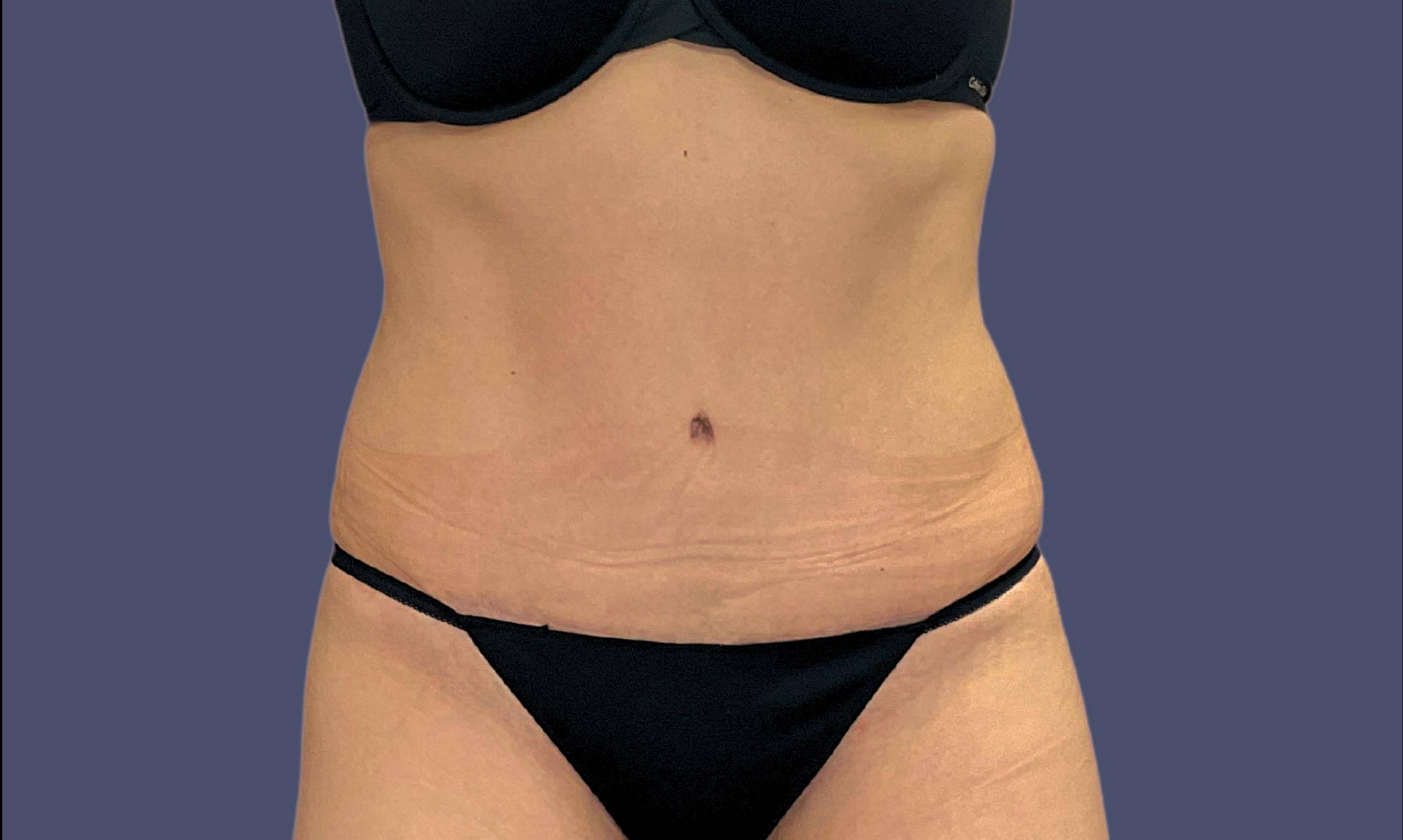 Abdominoplasty (Tummy Tuck) 16 After