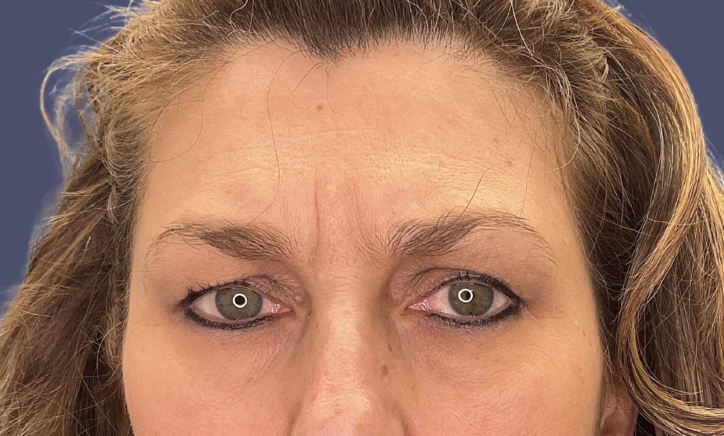 Blepharoplasty 14 - Upper Before