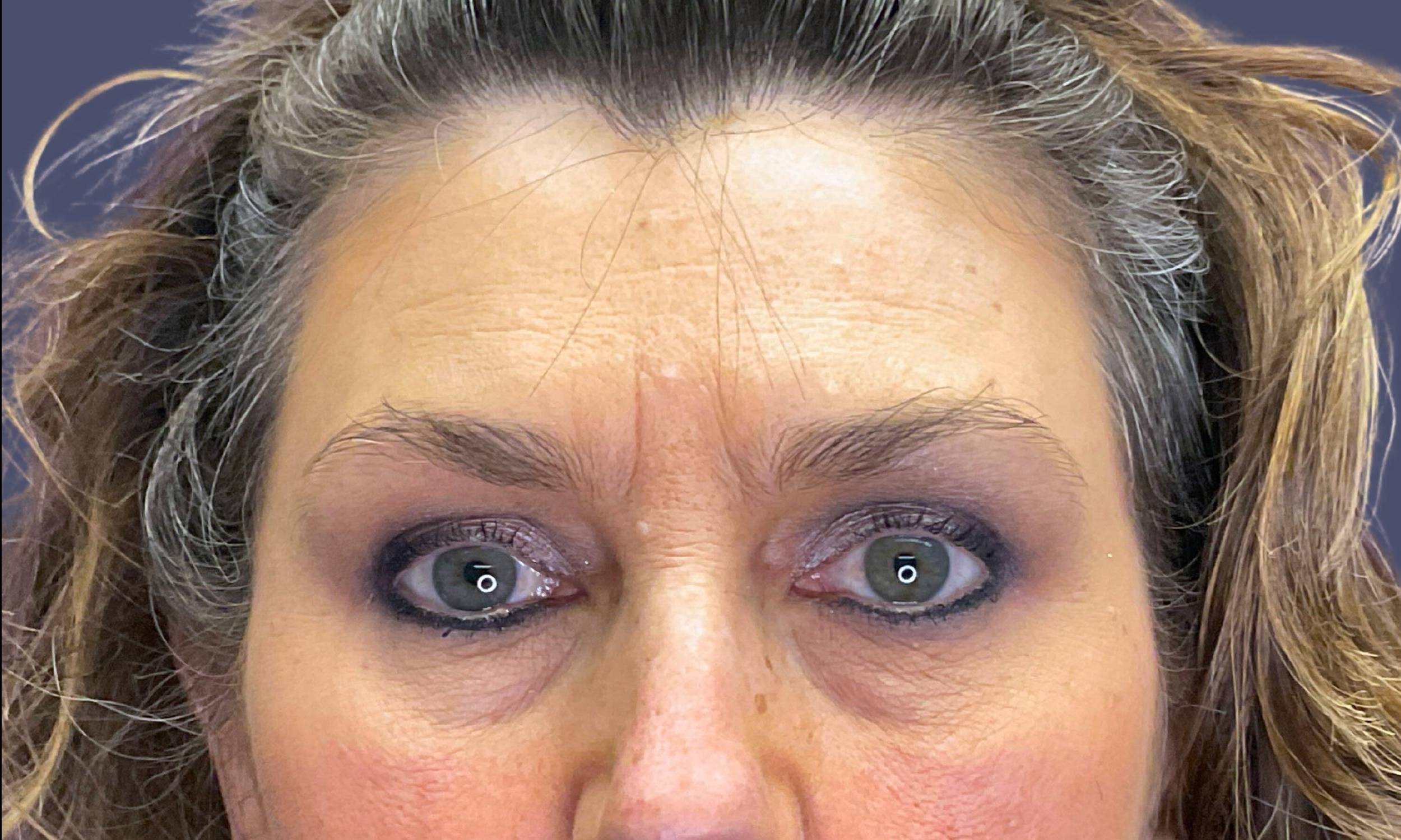 Upper Blepharoplasty 9 After