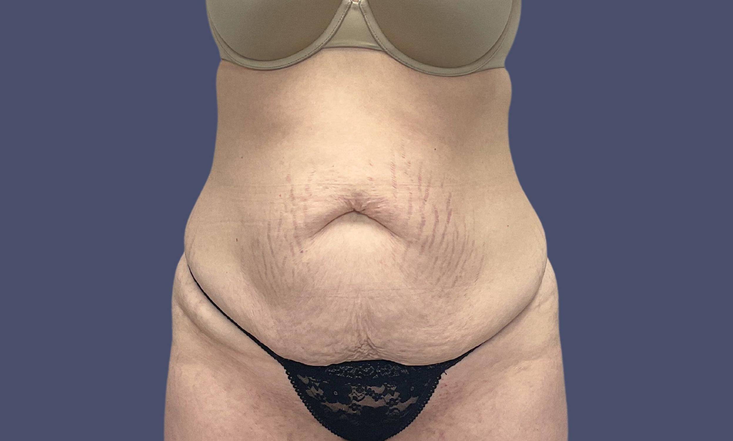 Abdominoplasty (Tummy Tuck) 6 Before