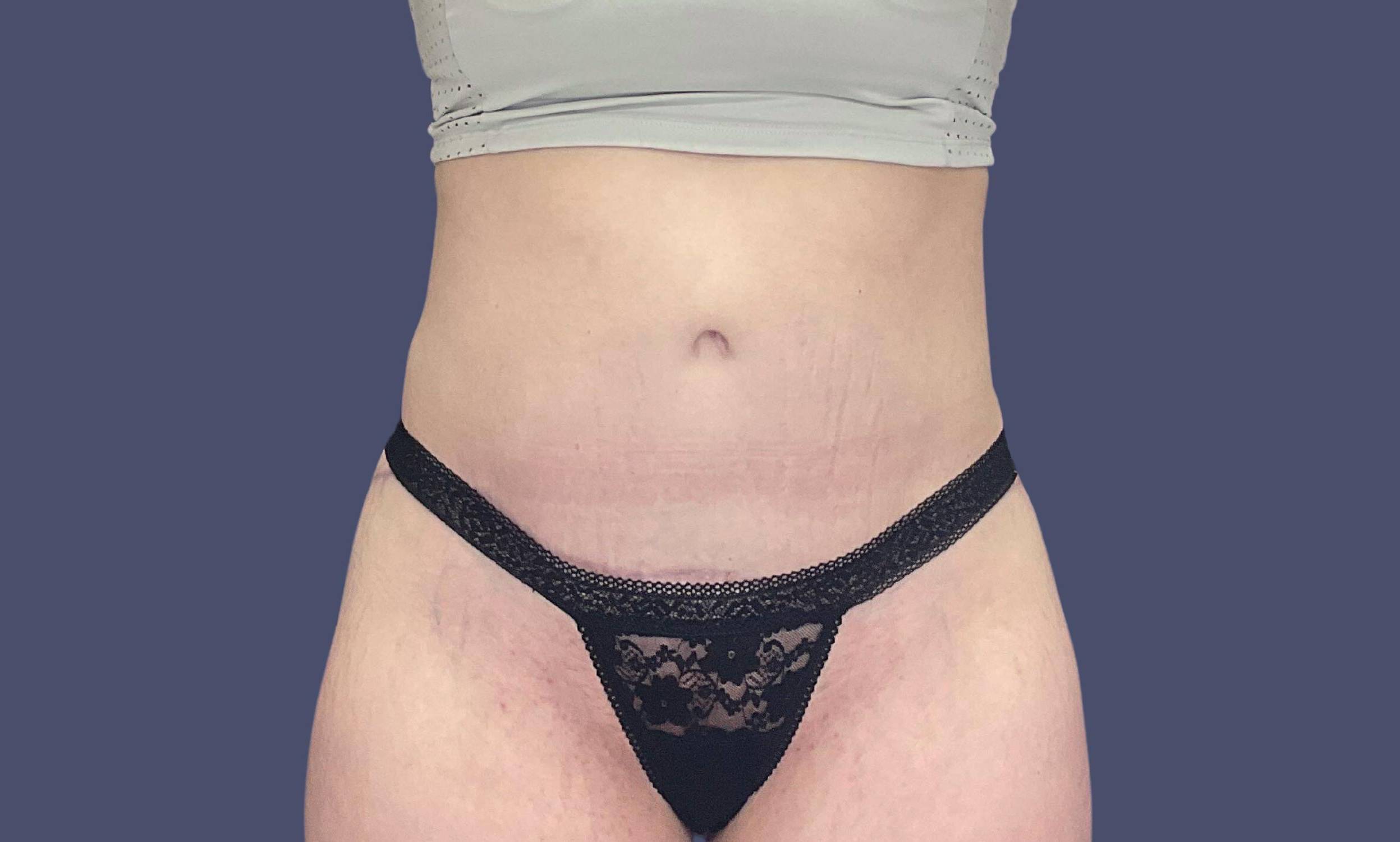 Abdominoplasty (Tummy Tuck) 6 After