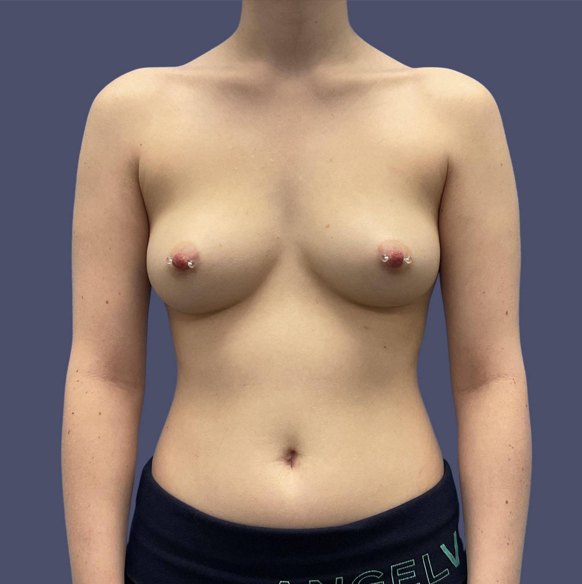 Breast Augmentation 10 Before