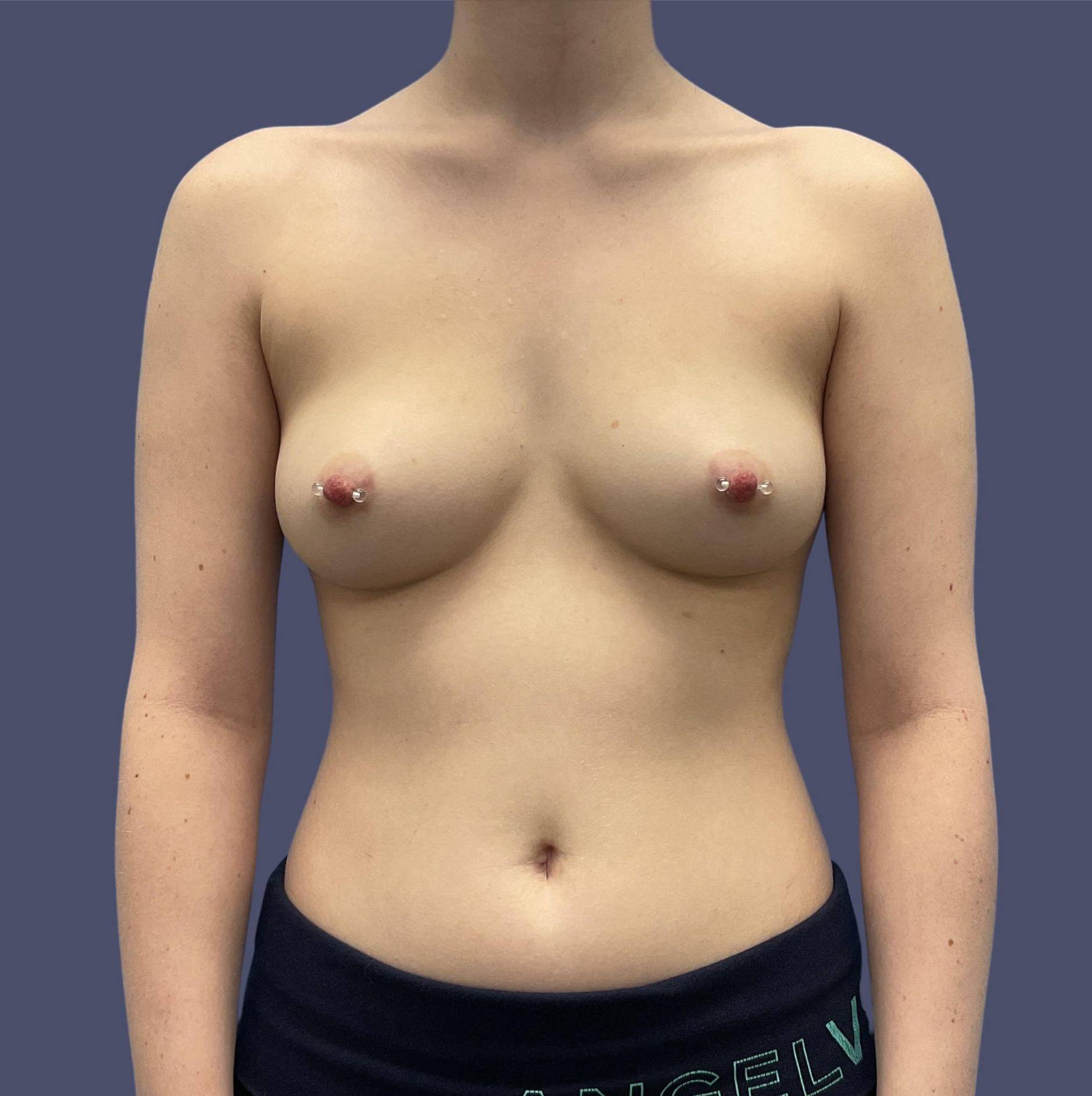 Breast Augmentation 11 Before