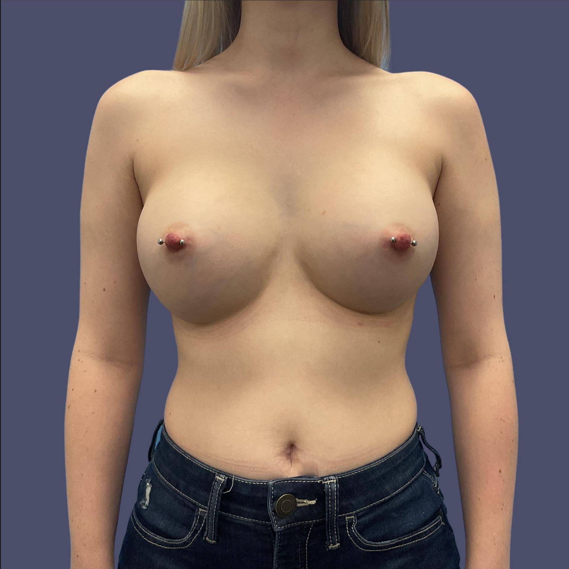 Breast Augmentation 10 After