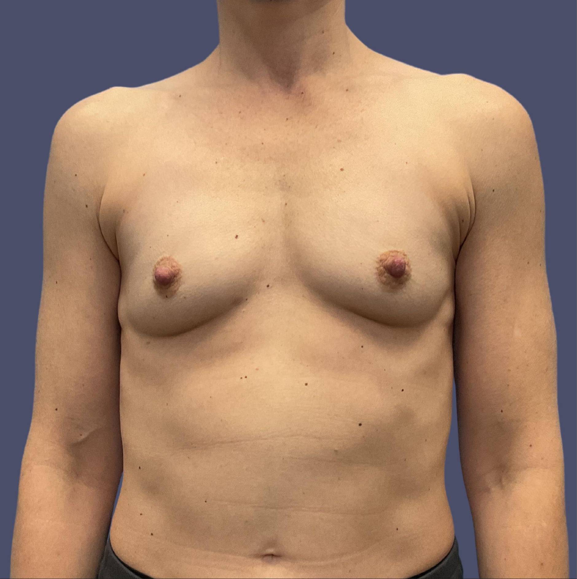 Breast Augmentation 24 Before