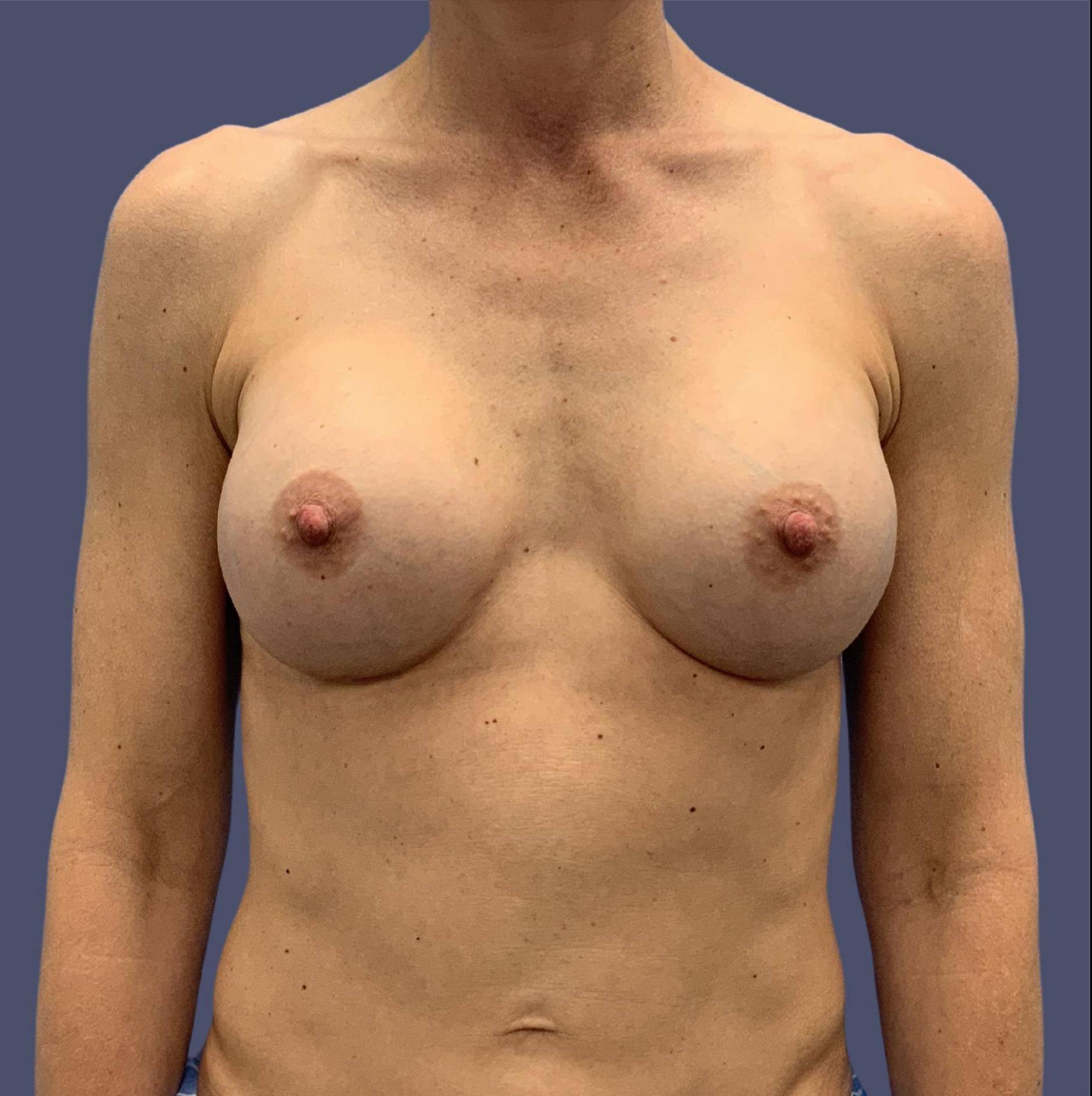 Breast Augmentation 24 After