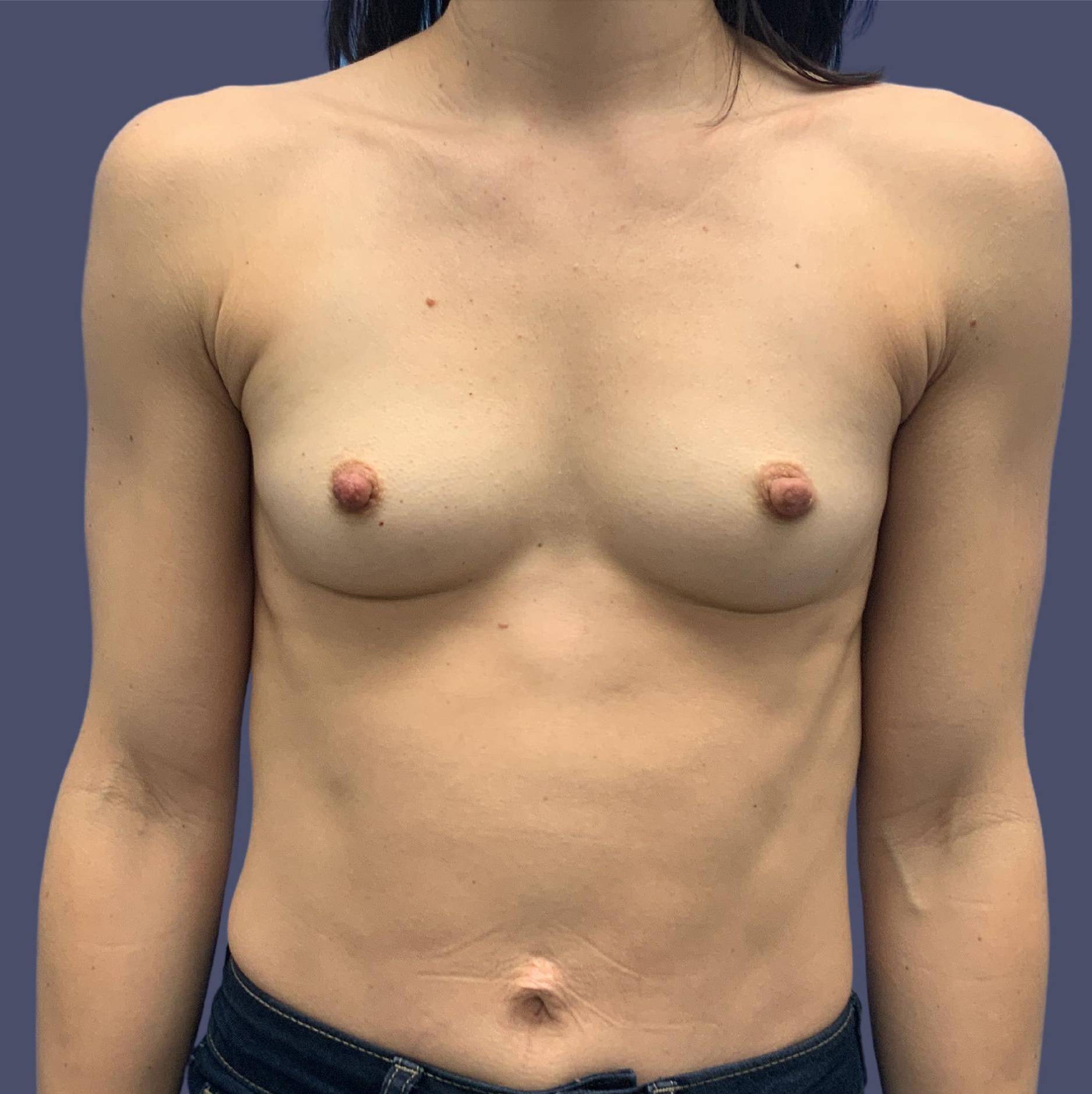 Breast Augmentation 43 Before