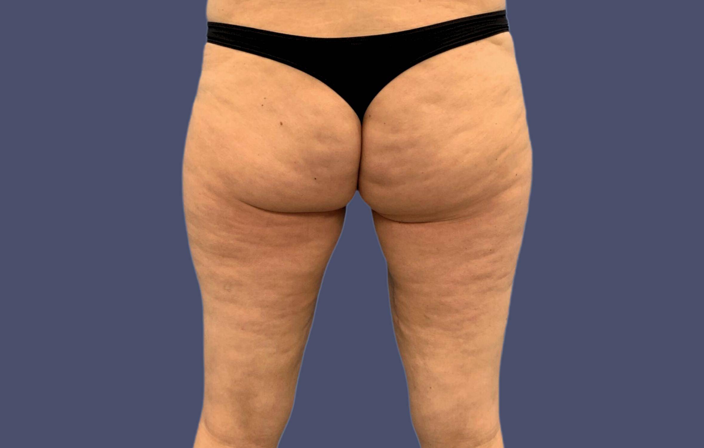 Thigh Lift 5 After